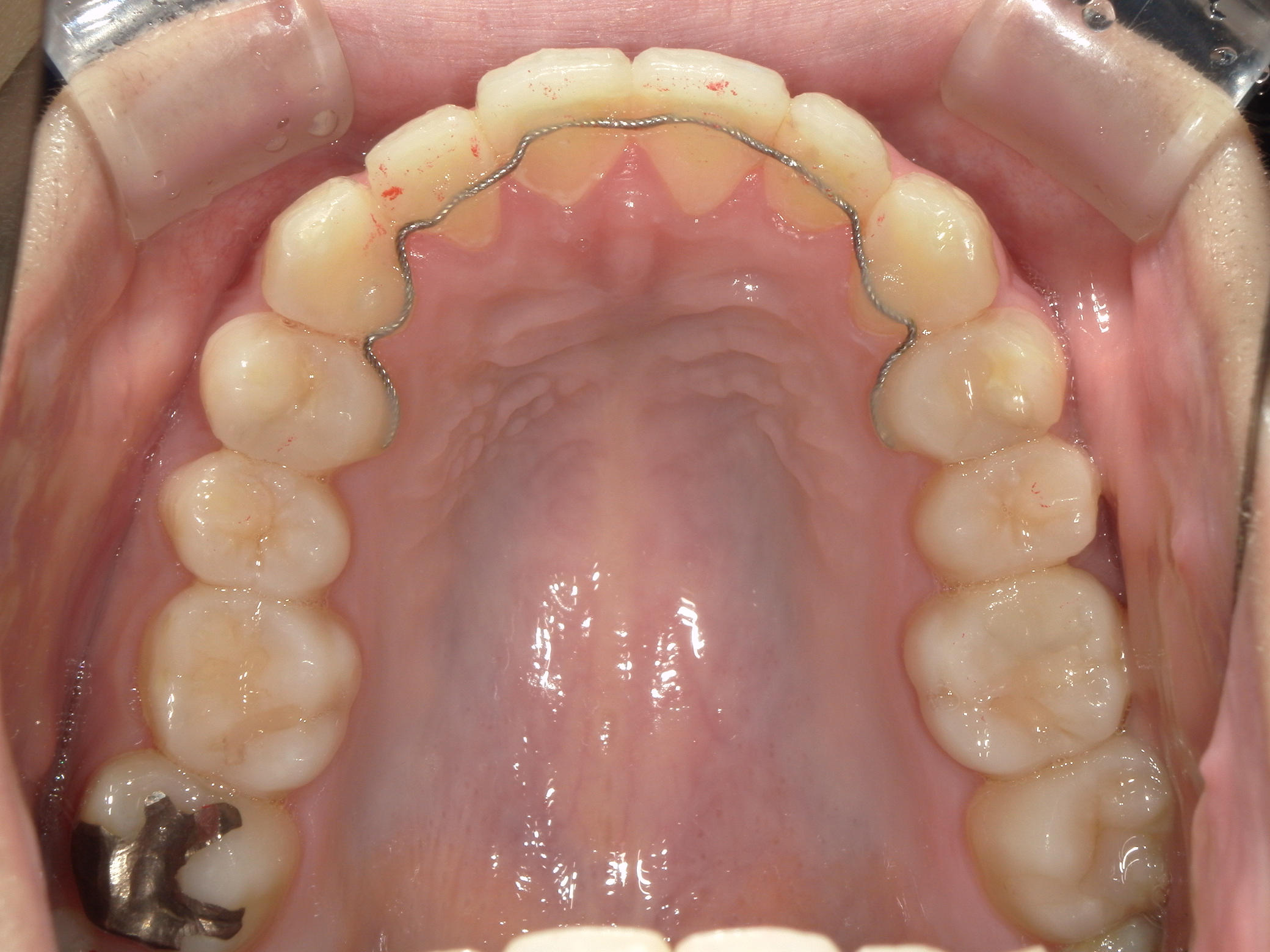 プチワイヤー矯正　症例（62）