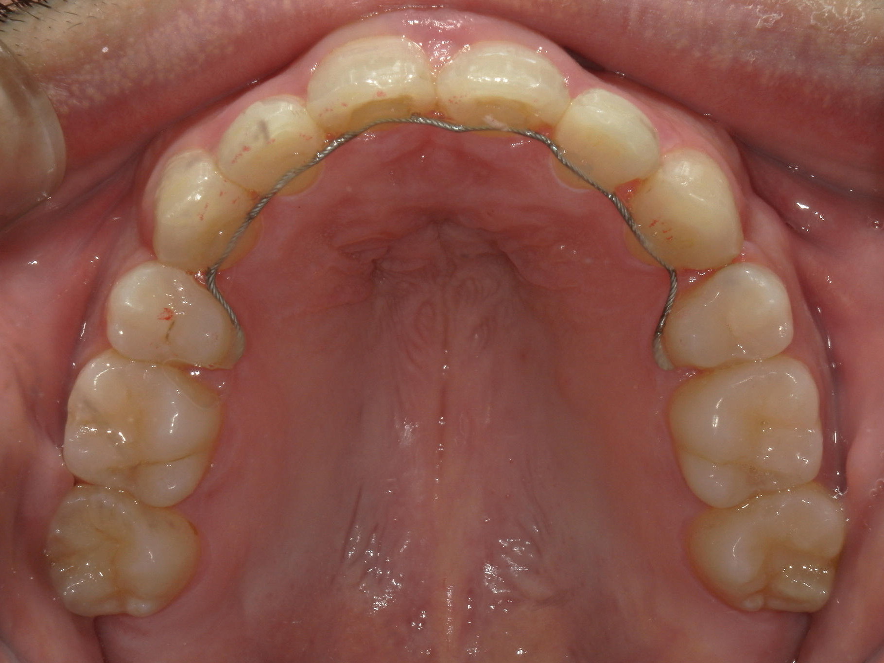 全顎ワイヤー矯正　症例（79）