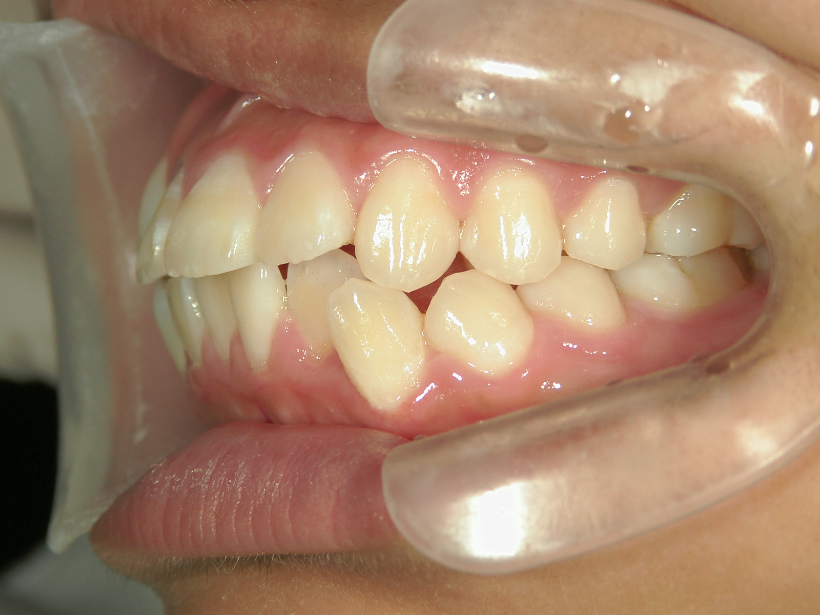 全顎ワイヤー矯正　症例（80）