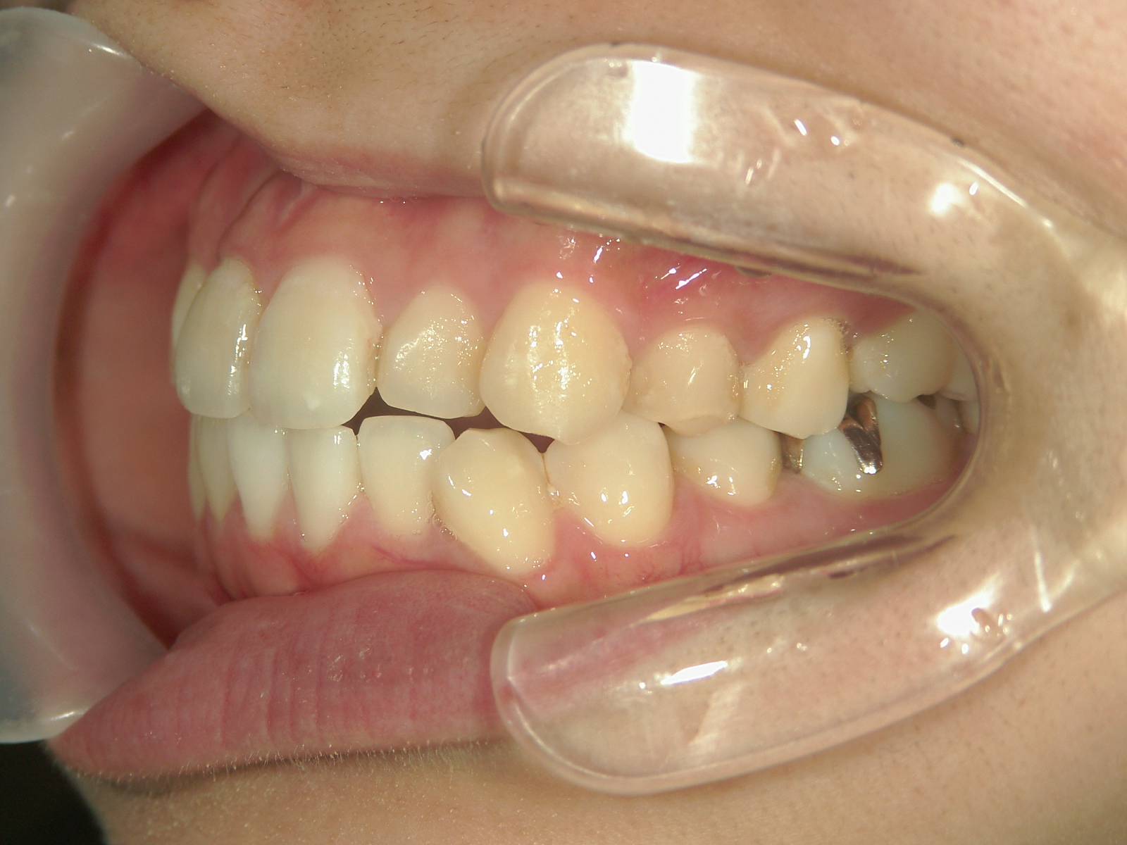 プチワイヤー矯正　症例（62）