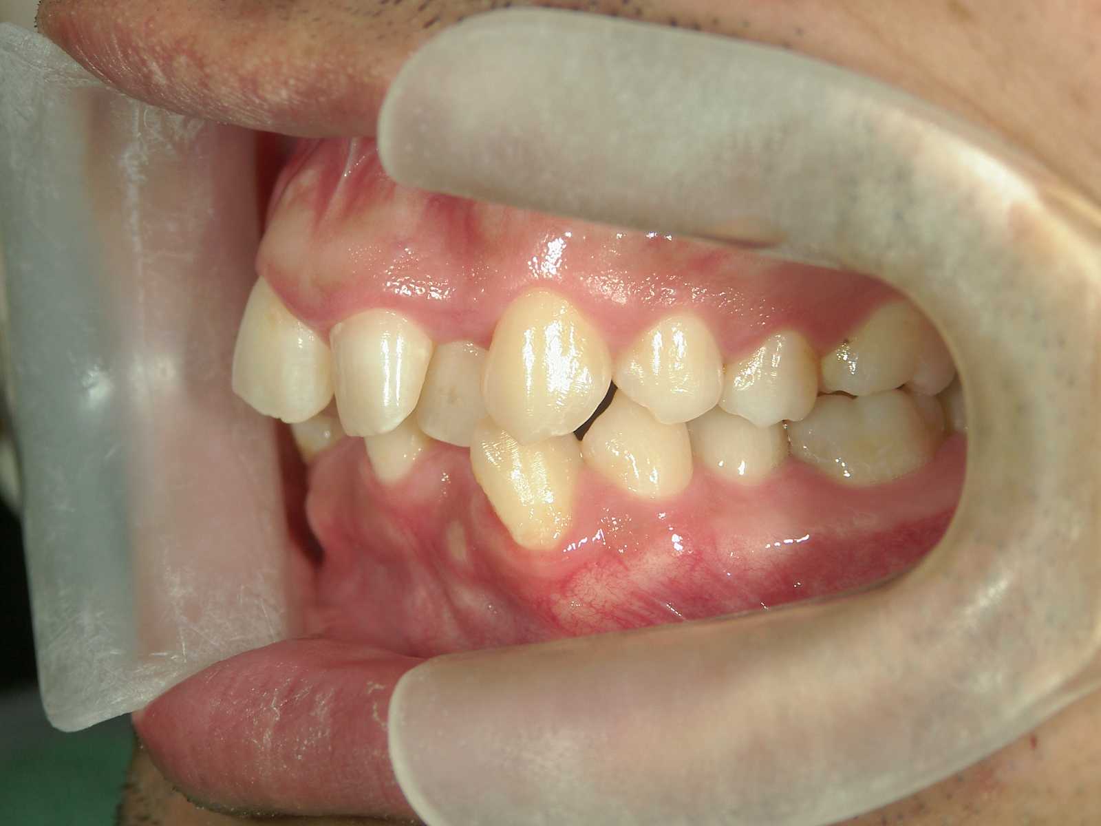 全顎ワイヤー矯正　症例（79）