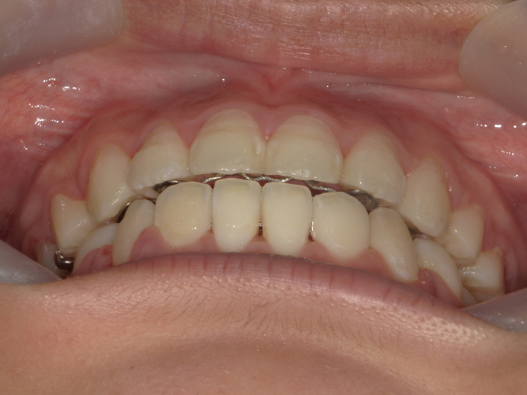 全顎ワイヤー矯正　症例（80）