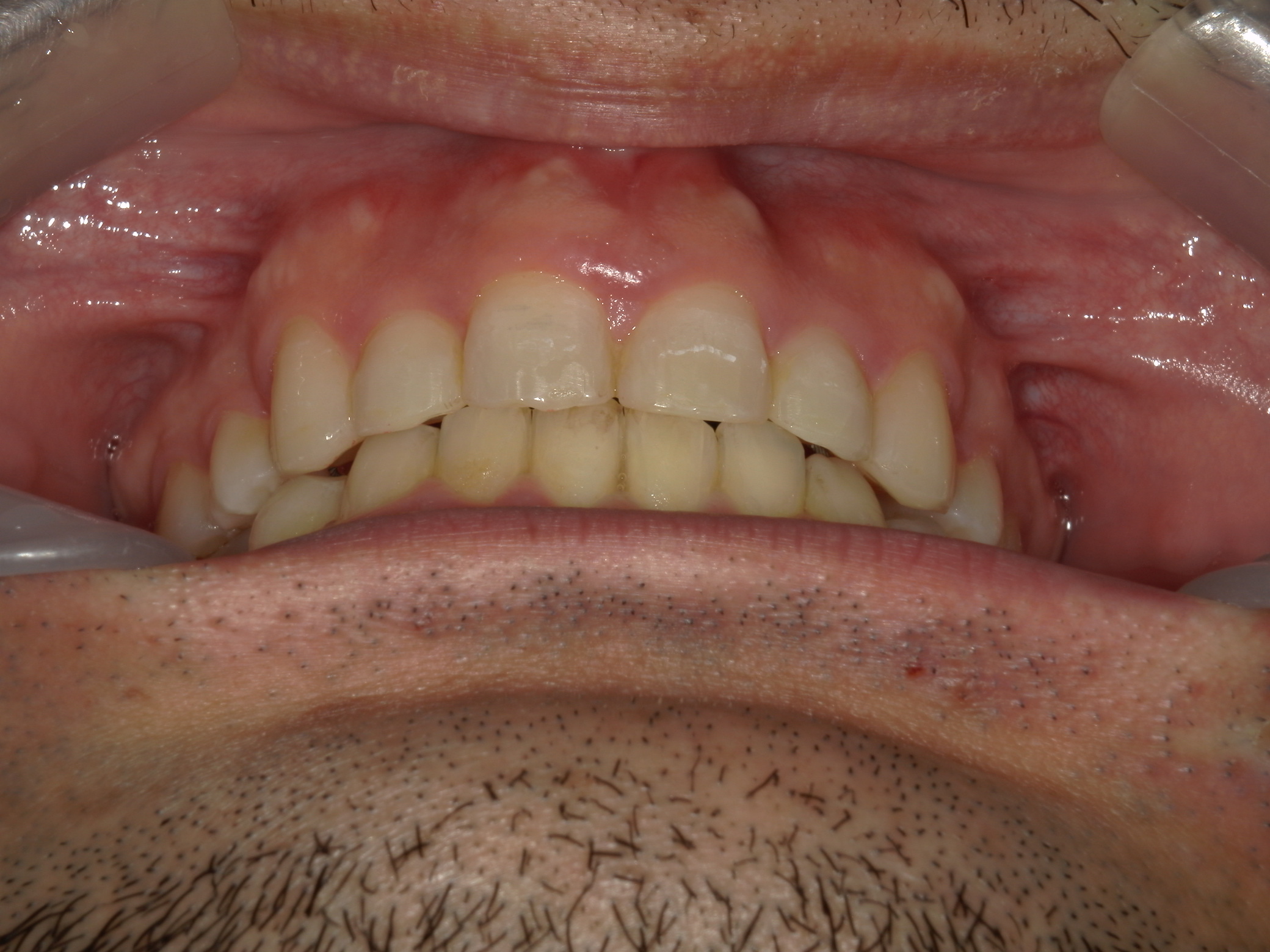 全顎ワイヤー矯正　症例（79）