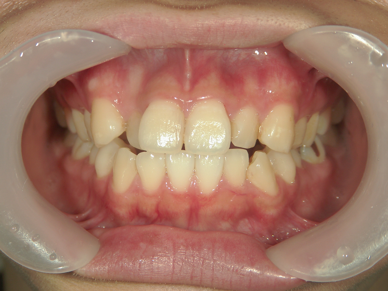 プチワイヤー矯正　症例（62）