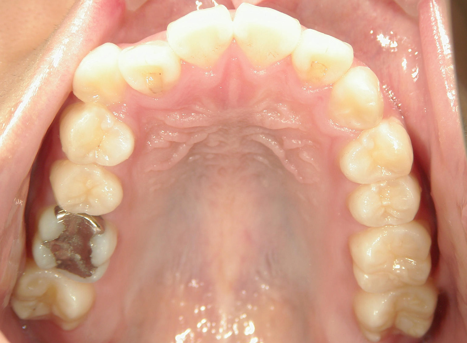 全顎ワイヤー矯正　症例（80）