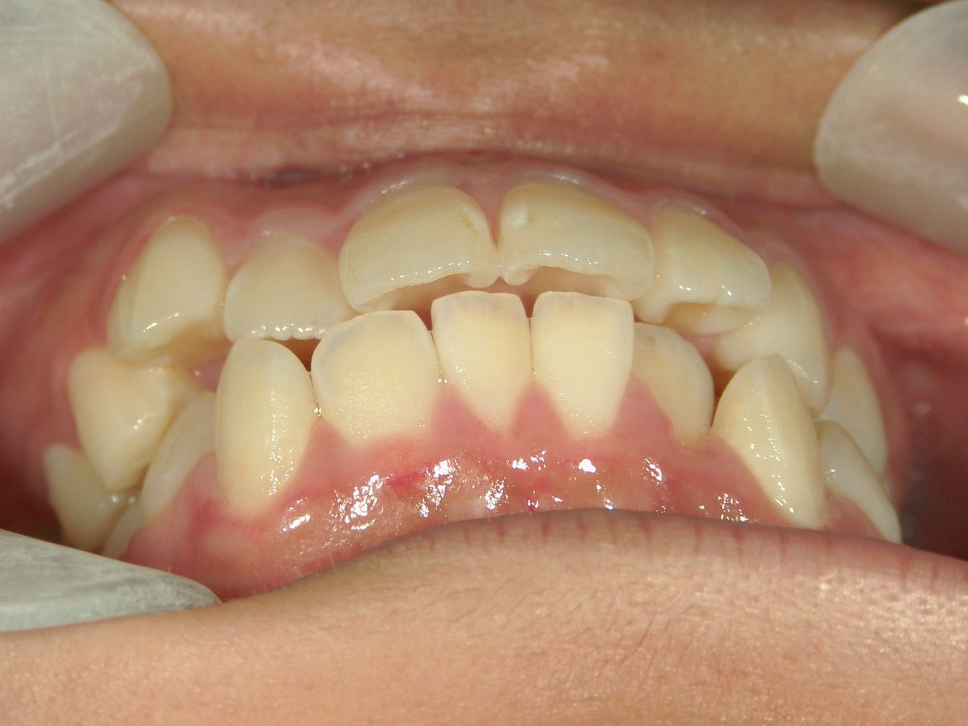 全顎ワイヤー矯正　症例（80）