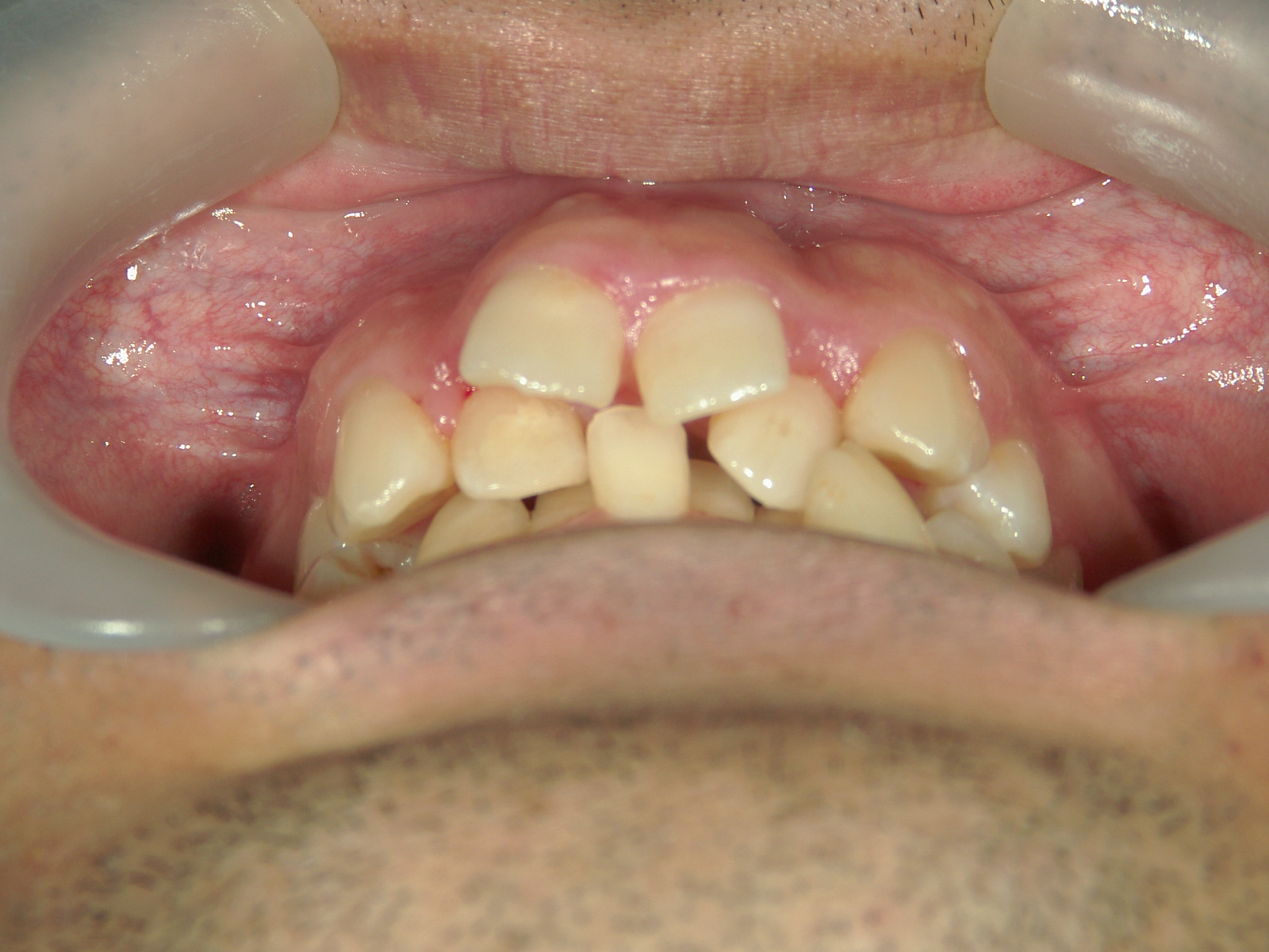 全顎ワイヤー矯正　症例（79）