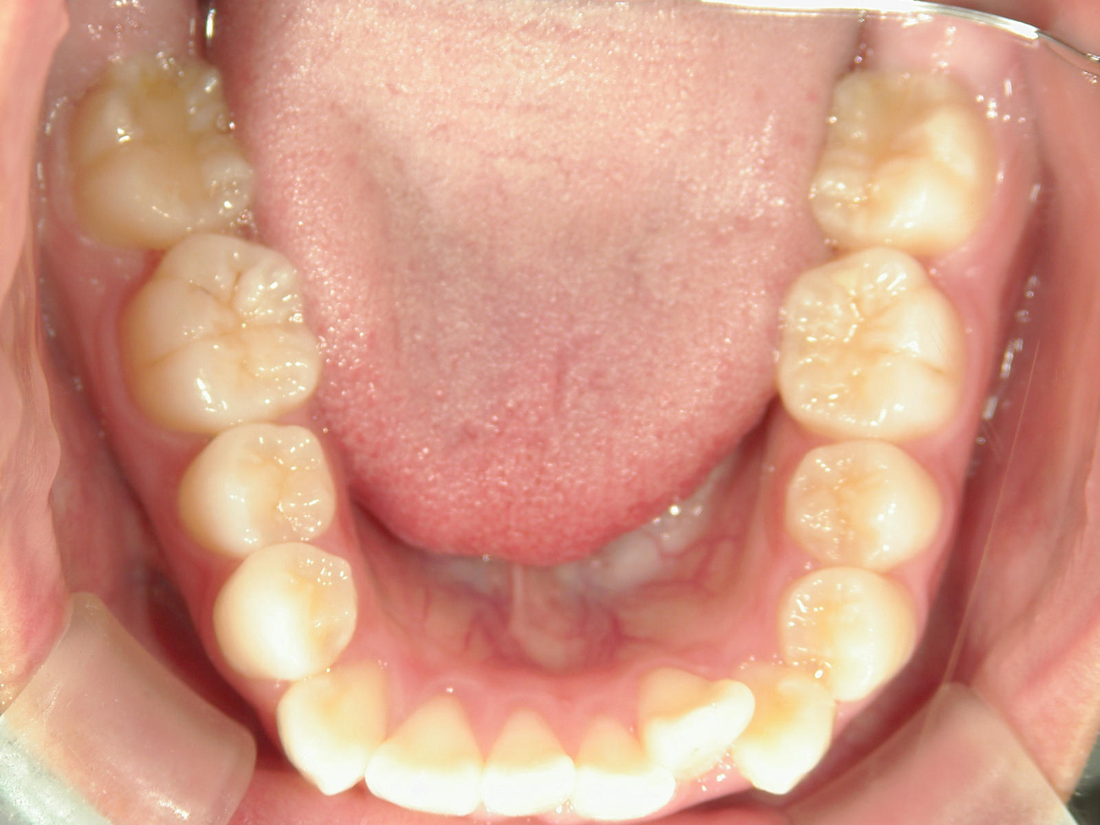 全顎ワイヤー矯正　症例（80）