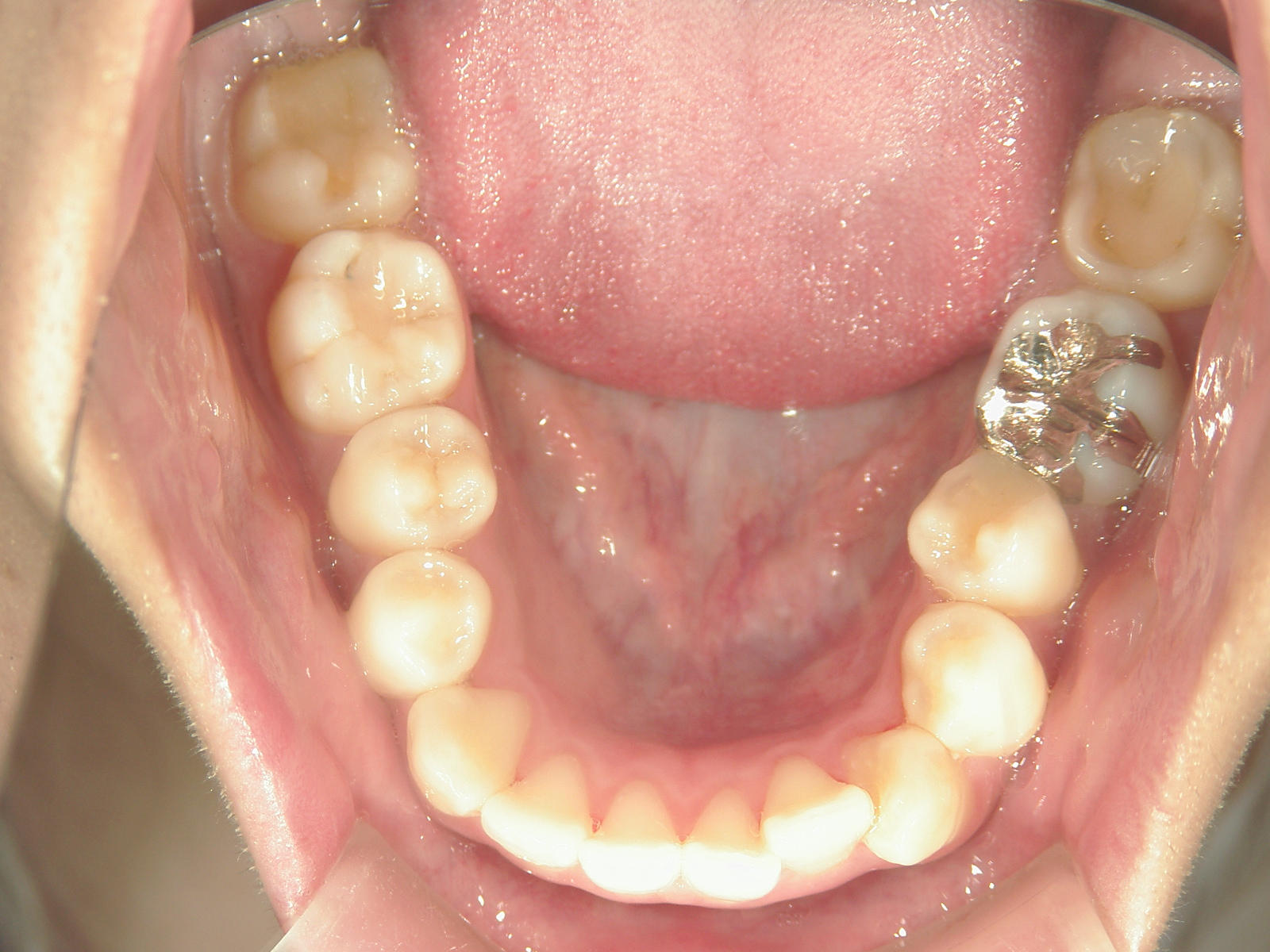 プチワイヤー矯正　症例（62）