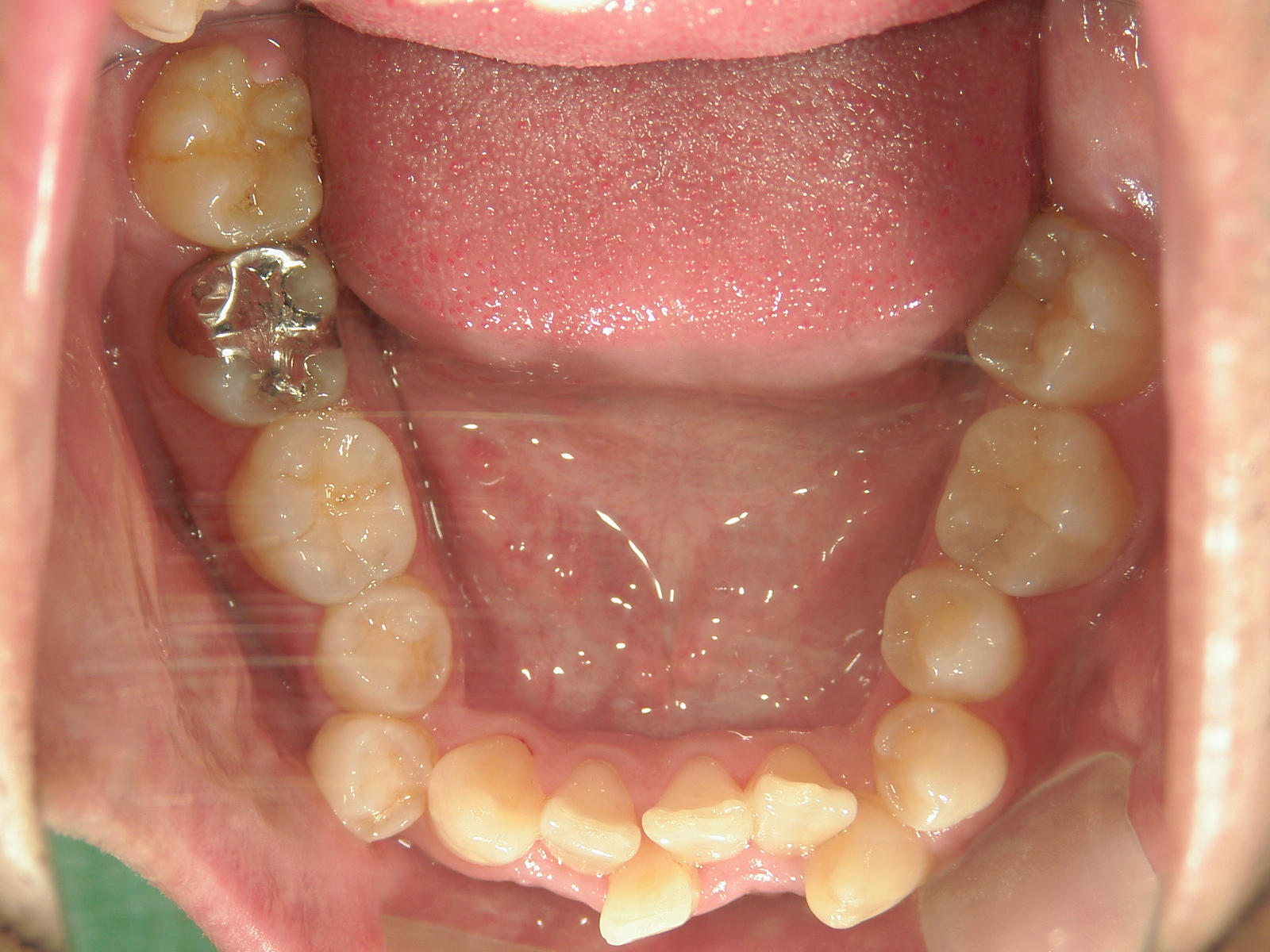 全顎ワイヤー矯正　症例（79）