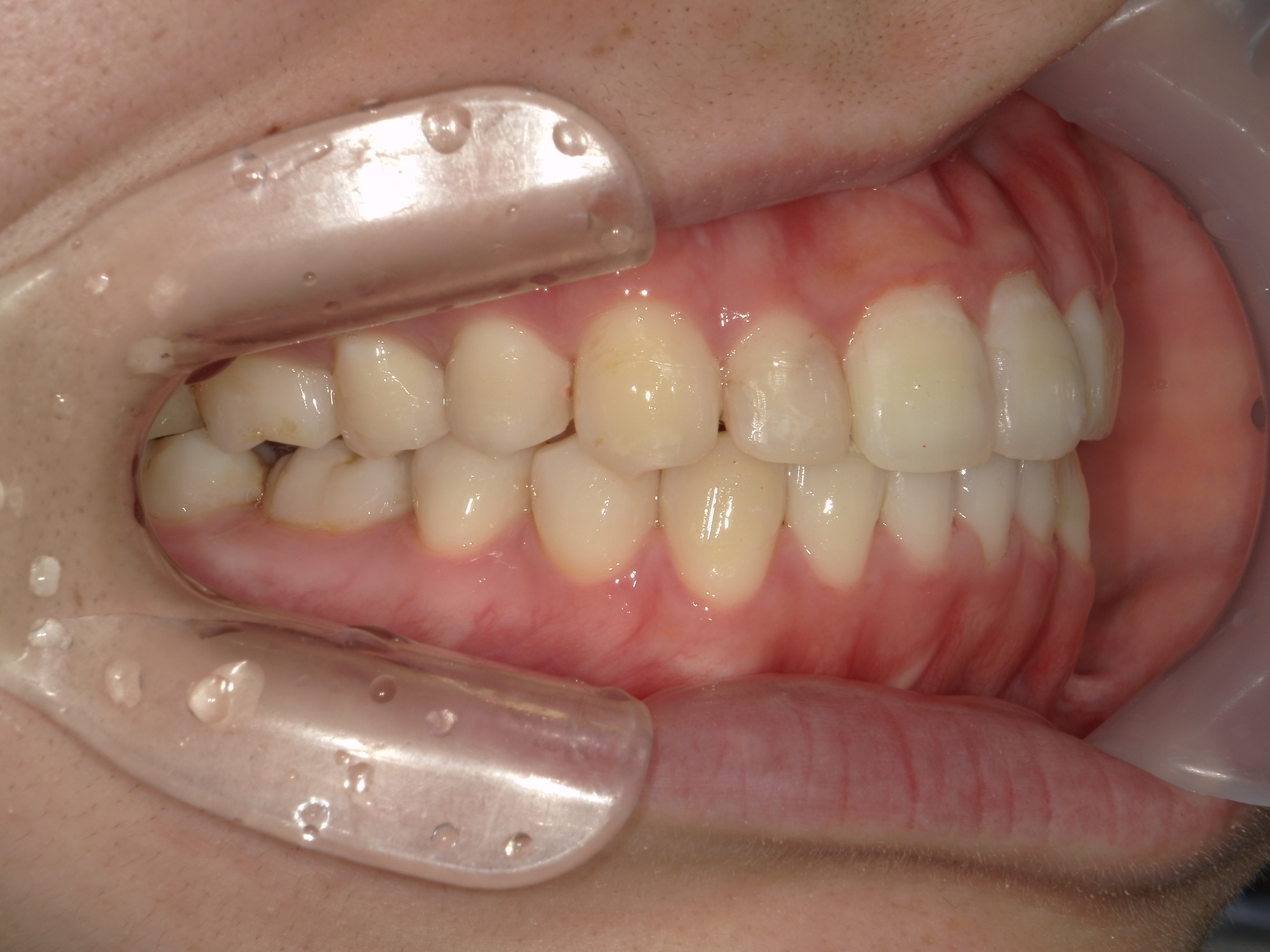 プチワイヤー矯正　症例（62）