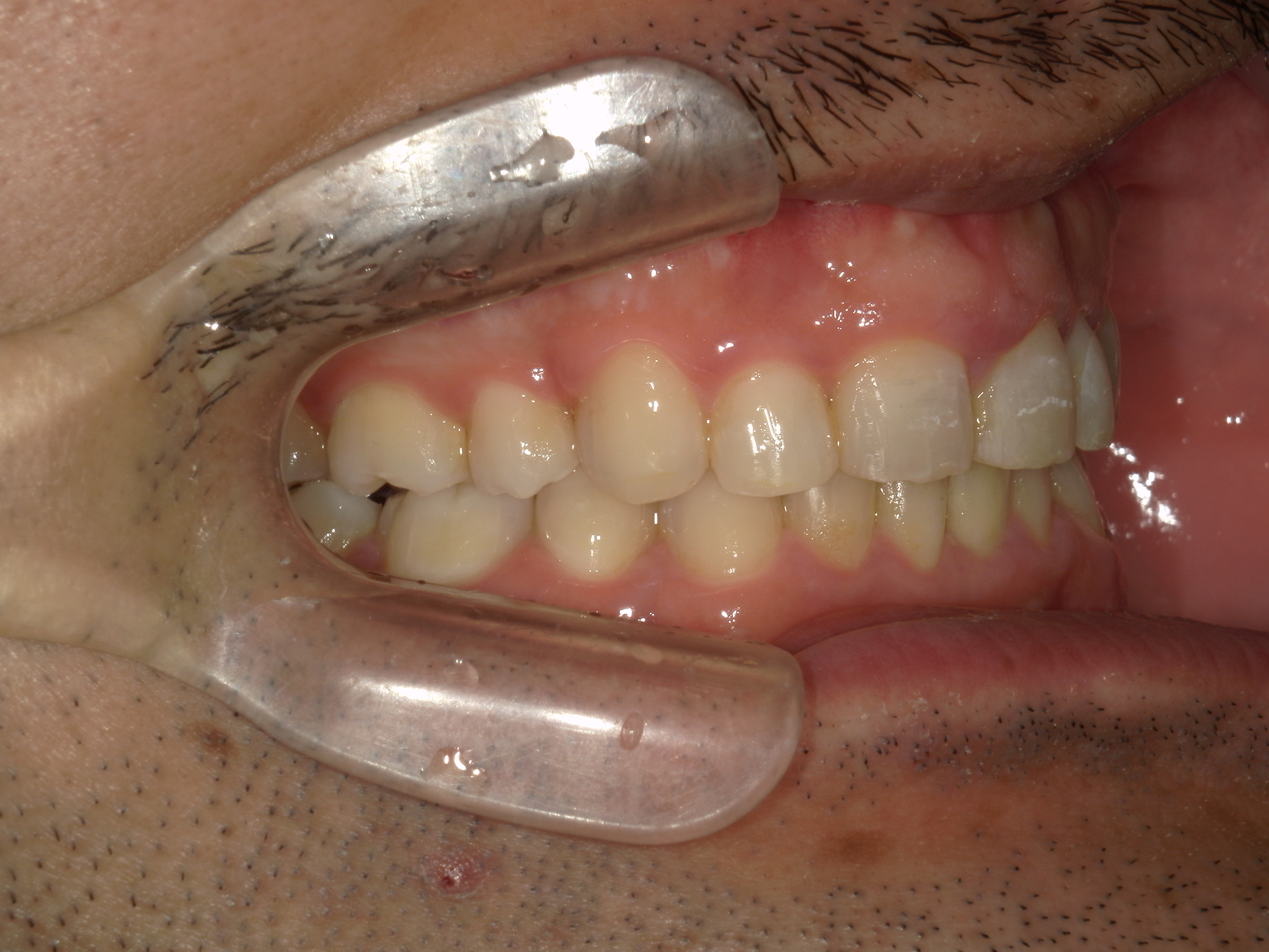 全顎ワイヤー矯正　症例（79）