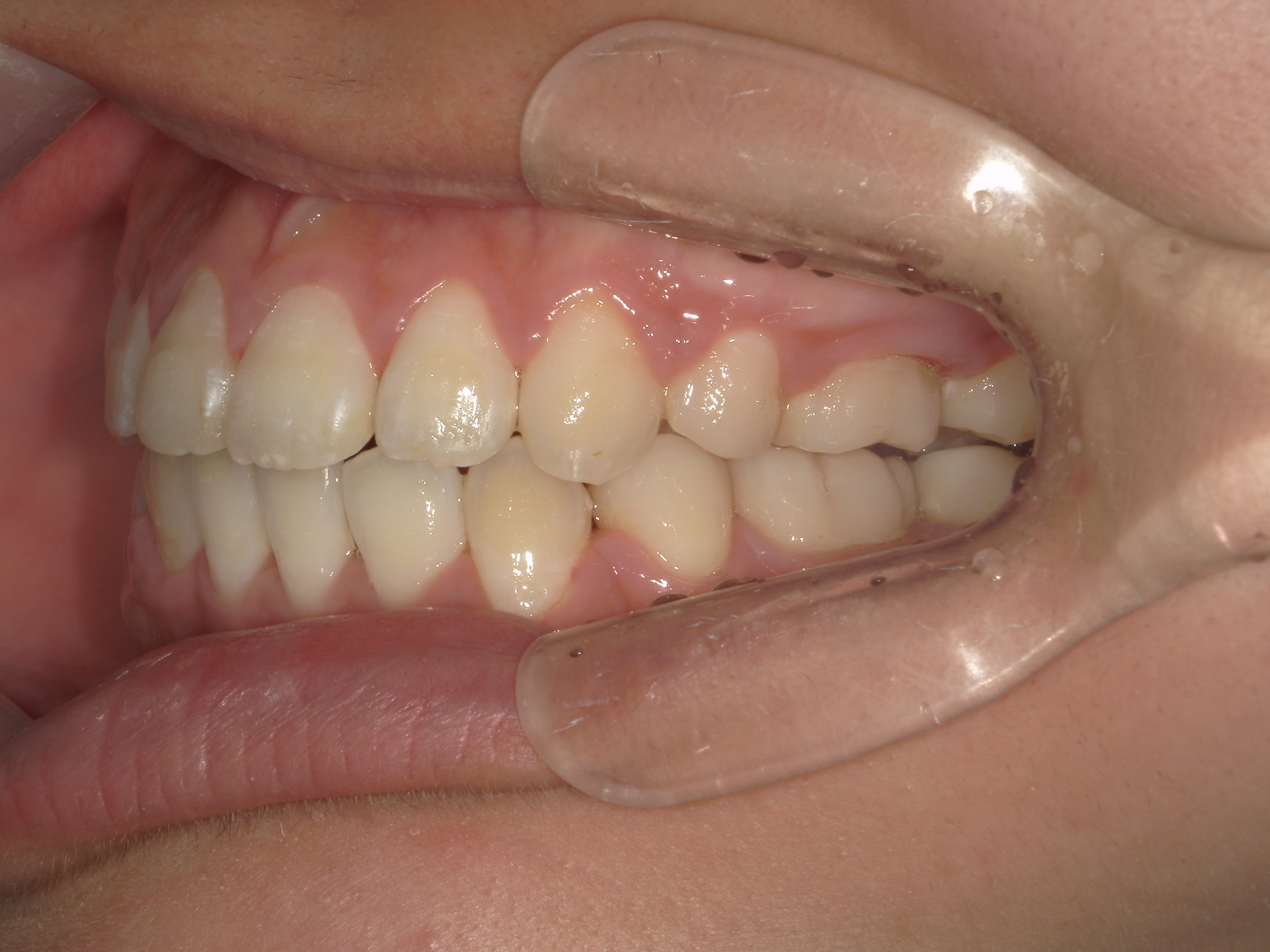 全顎ワイヤー矯正　症例（80）