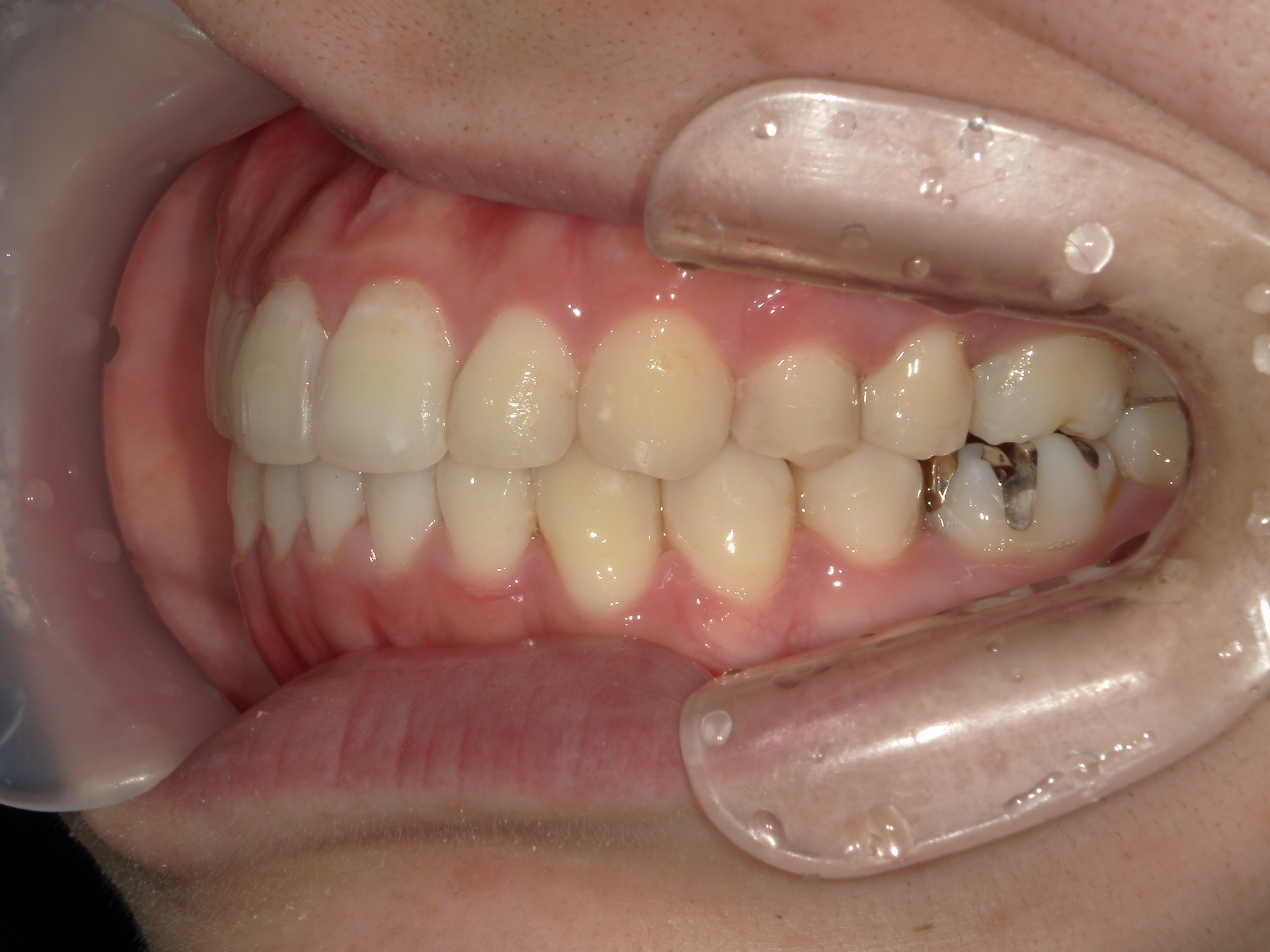 プチワイヤー矯正　症例（62）