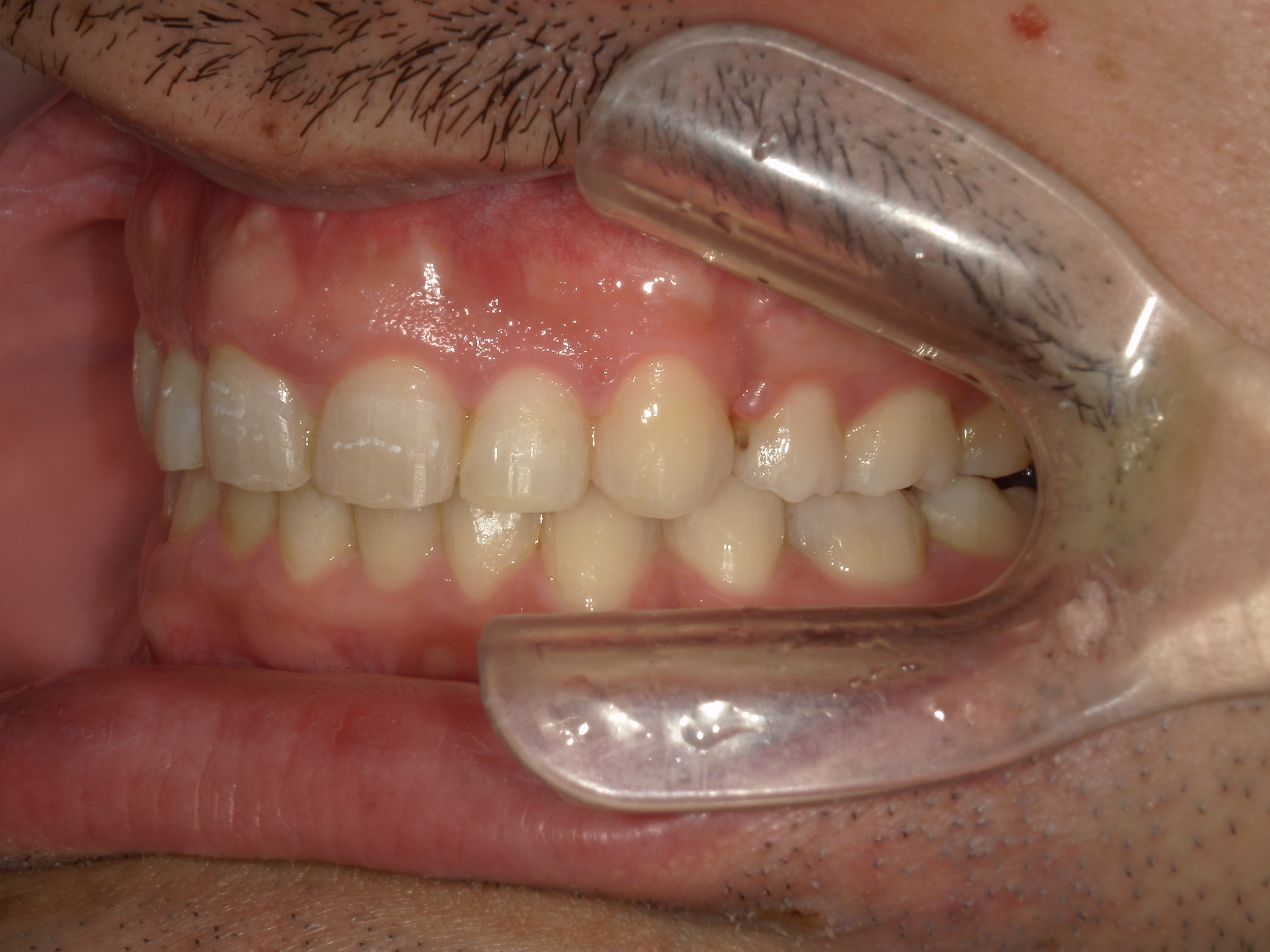 全顎ワイヤー矯正　症例（79）