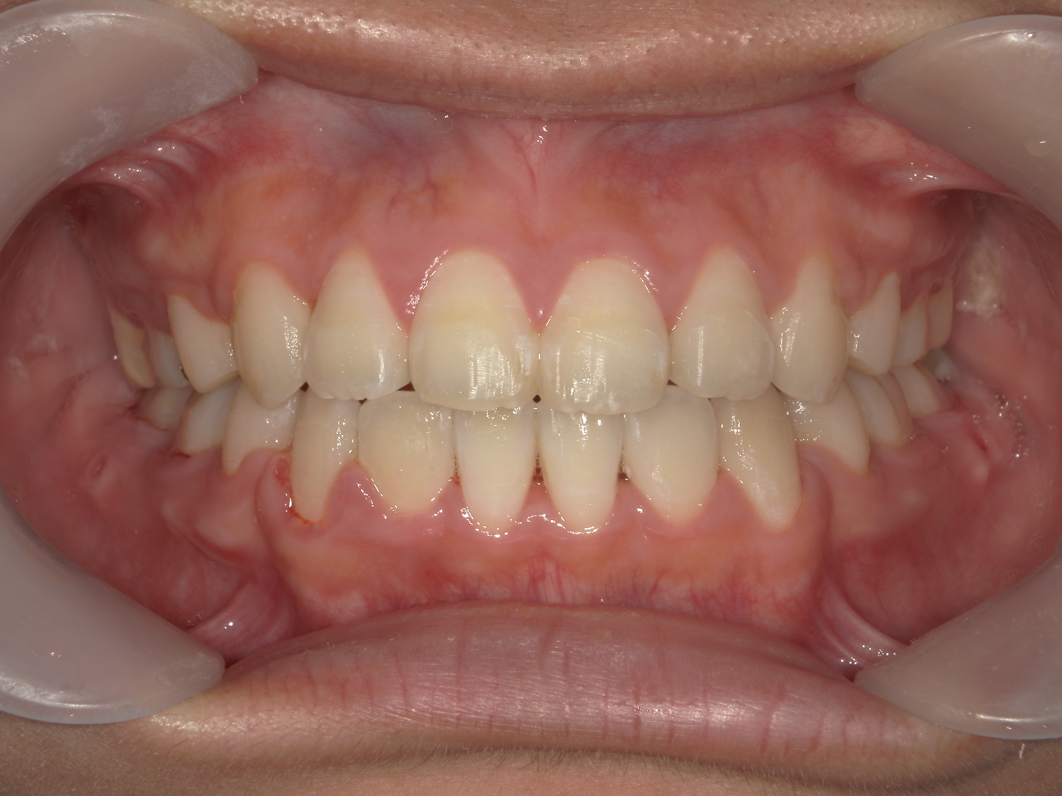 全顎ワイヤー矯正　症例（80）