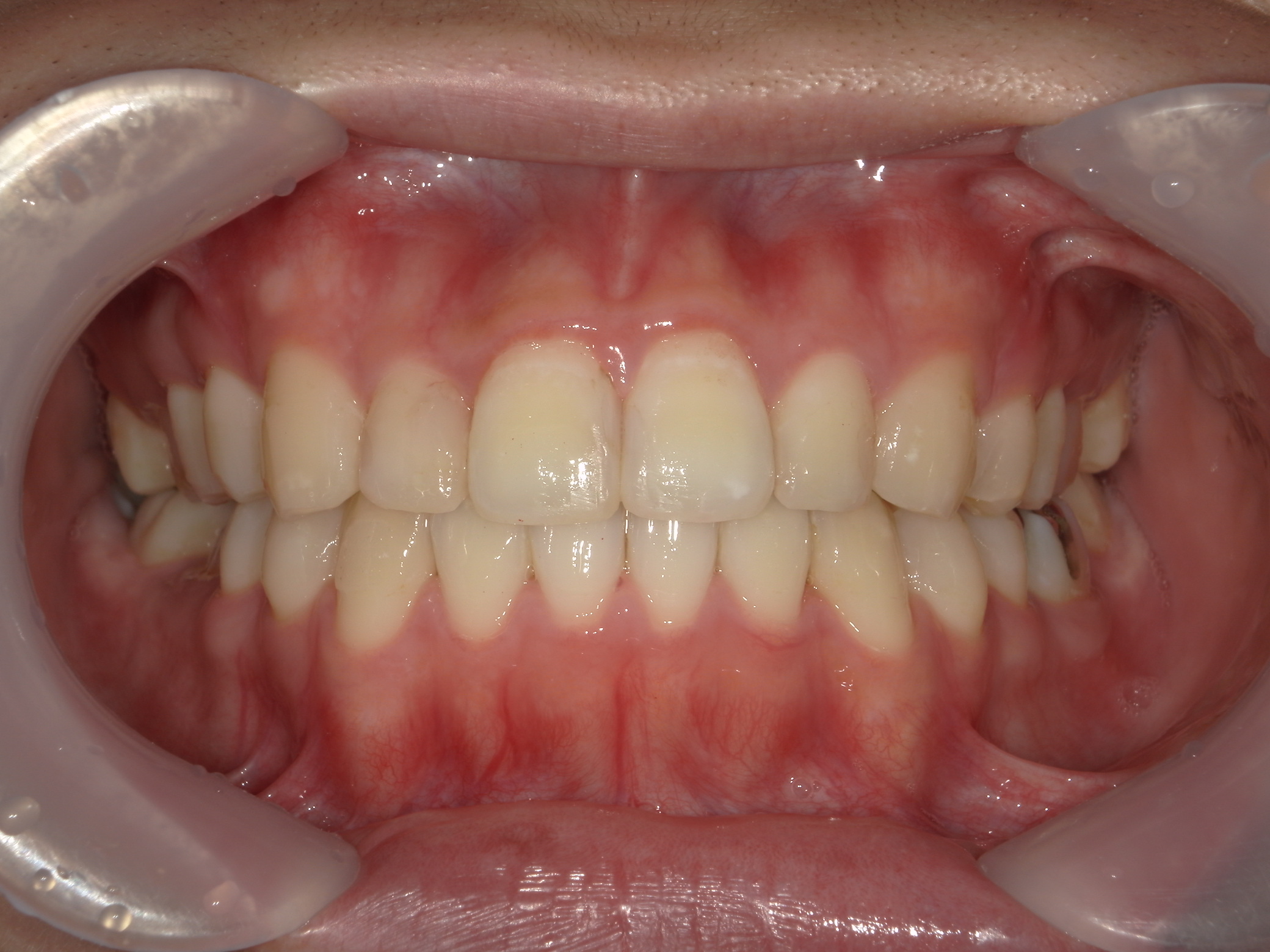 プチワイヤー矯正　症例（62）