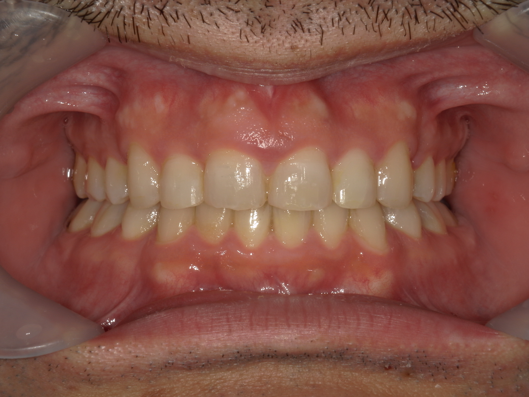 全顎ワイヤー矯正　症例（79）