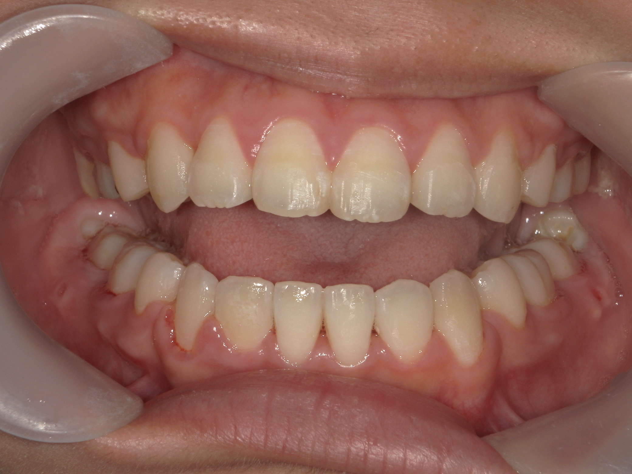 全顎ワイヤー矯正　症例（80）