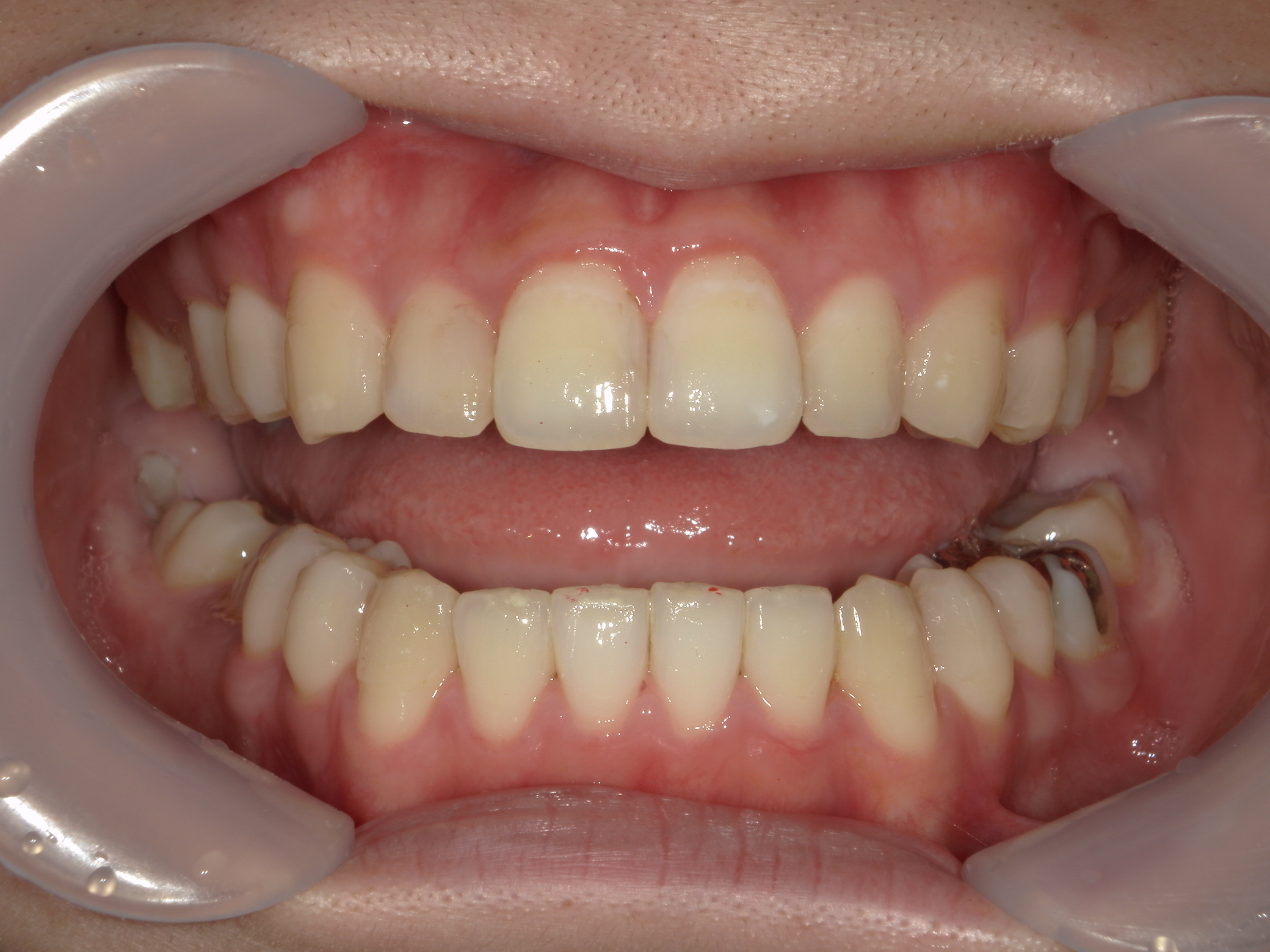 プチワイヤー矯正　症例（62）