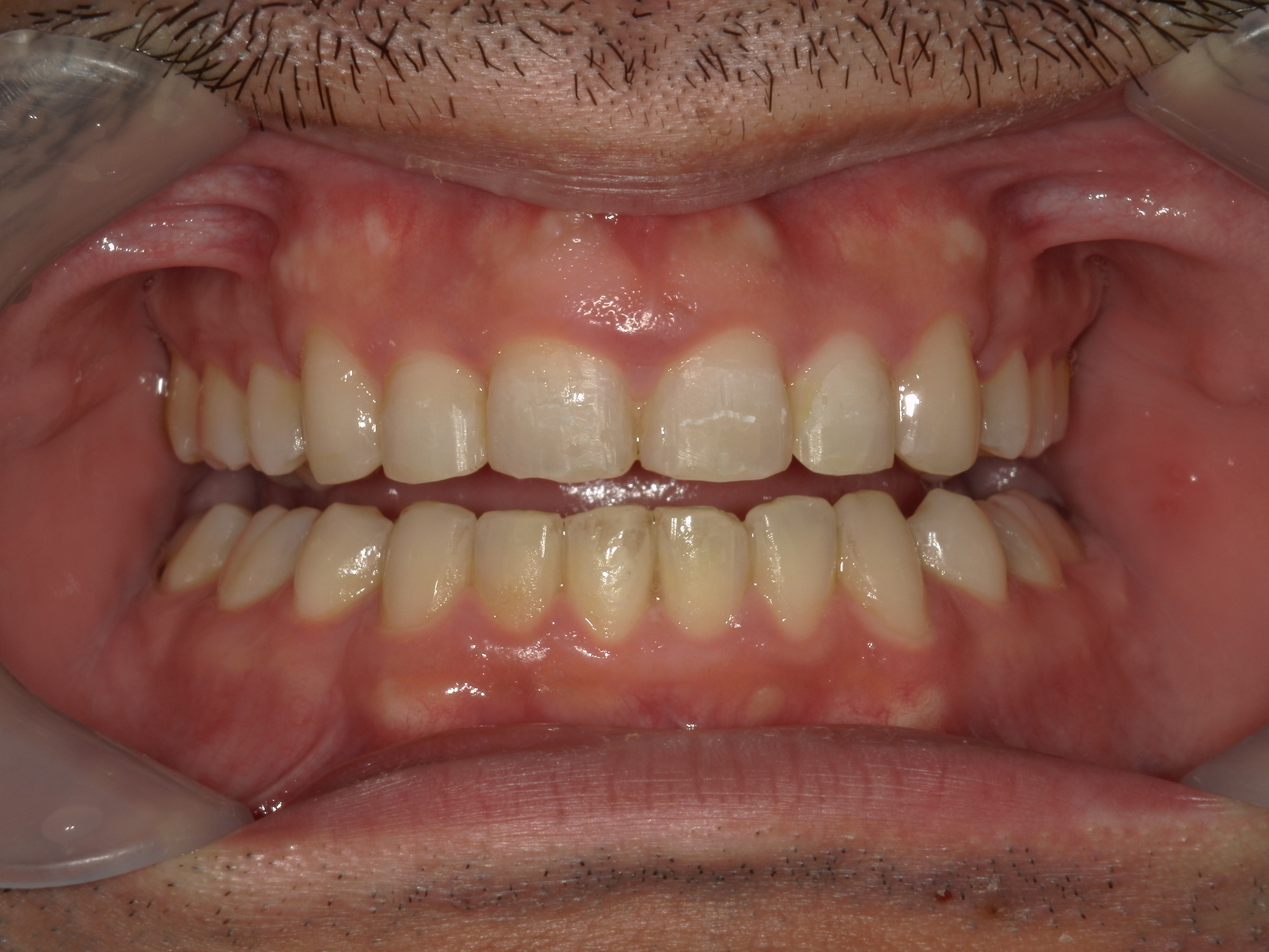 全顎ワイヤー矯正　症例（79）