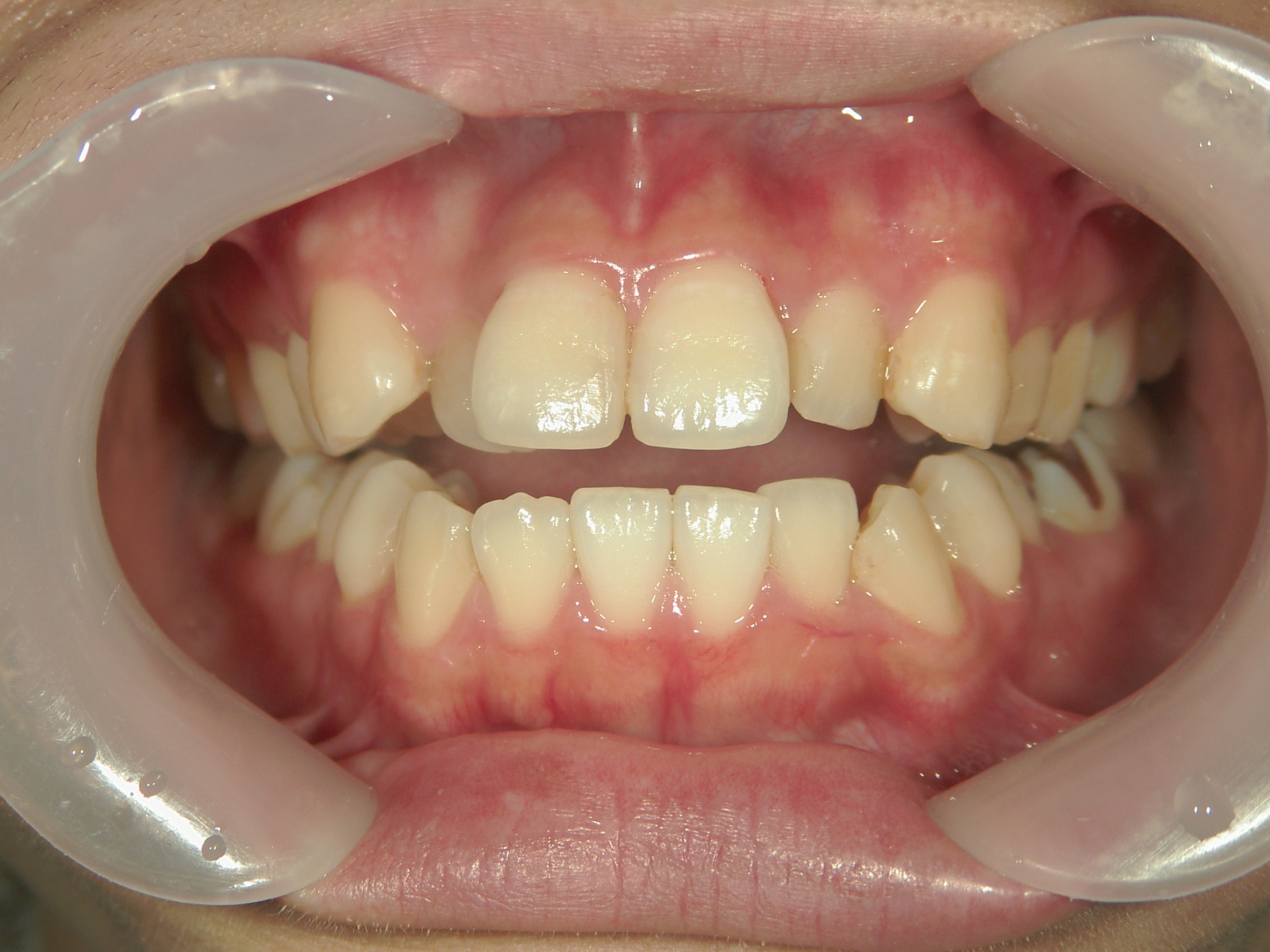 プチワイヤー矯正　症例（62）