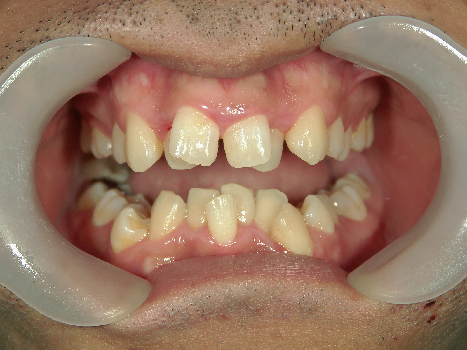 全顎ワイヤー矯正　症例（79）