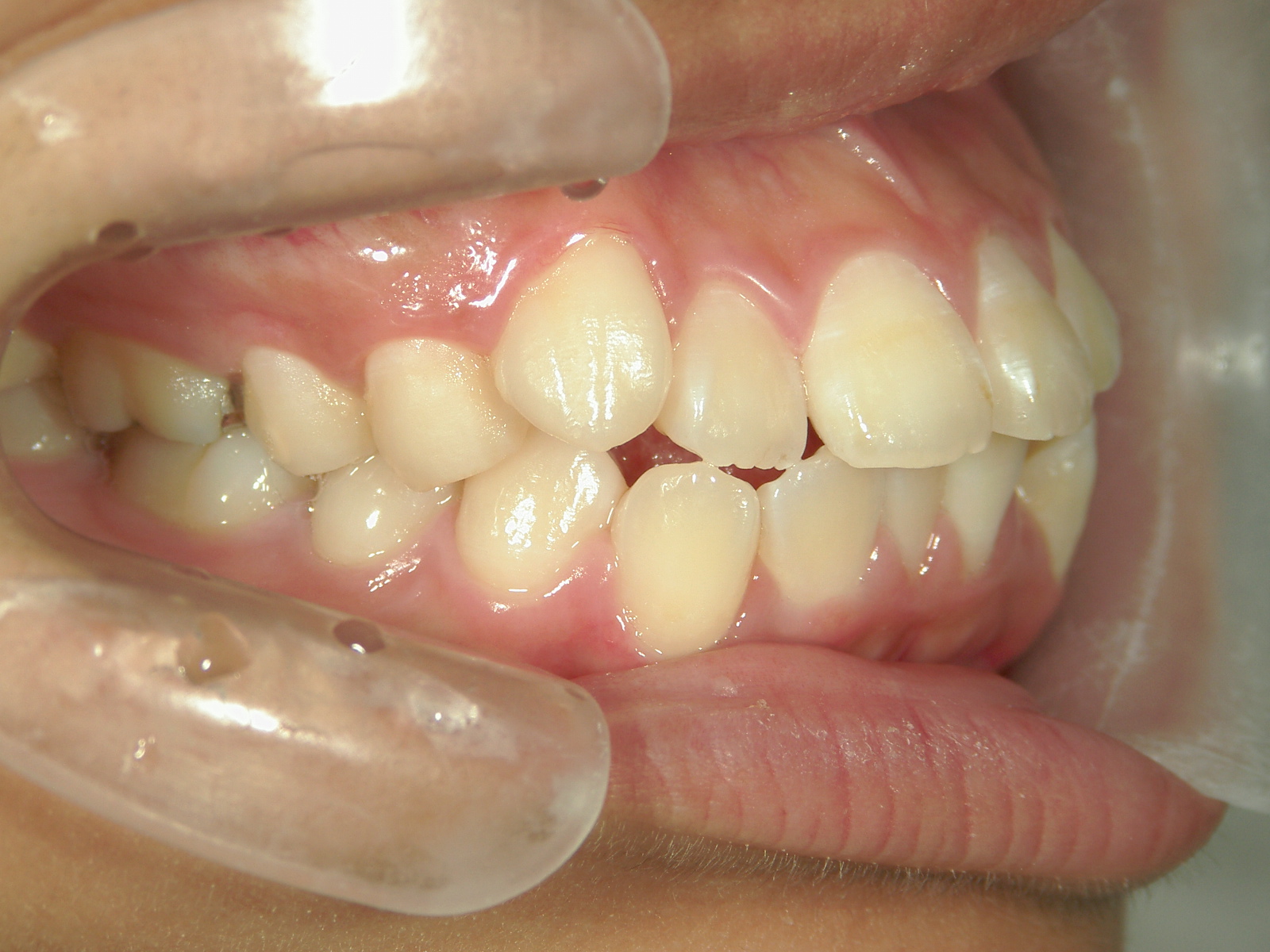 全顎ワイヤー矯正　症例（80）