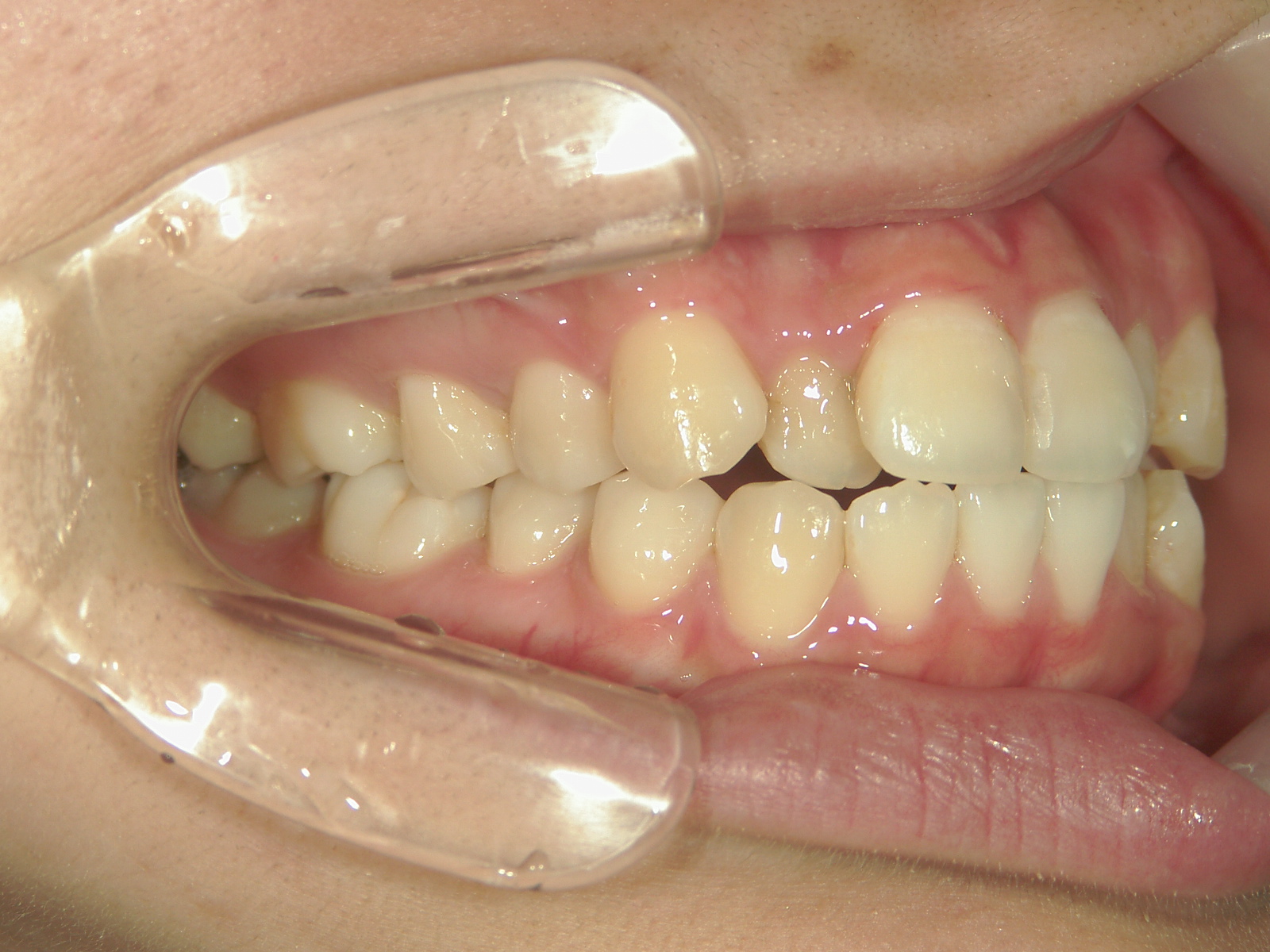 プチワイヤー矯正　症例（62）