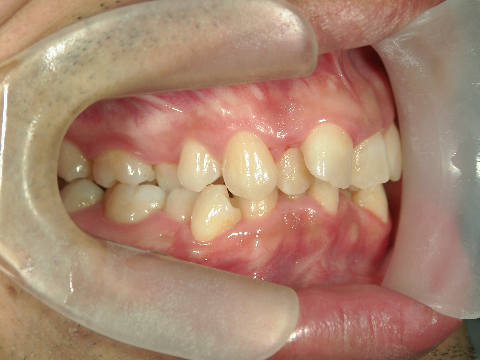 全顎ワイヤー矯正　症例（79）