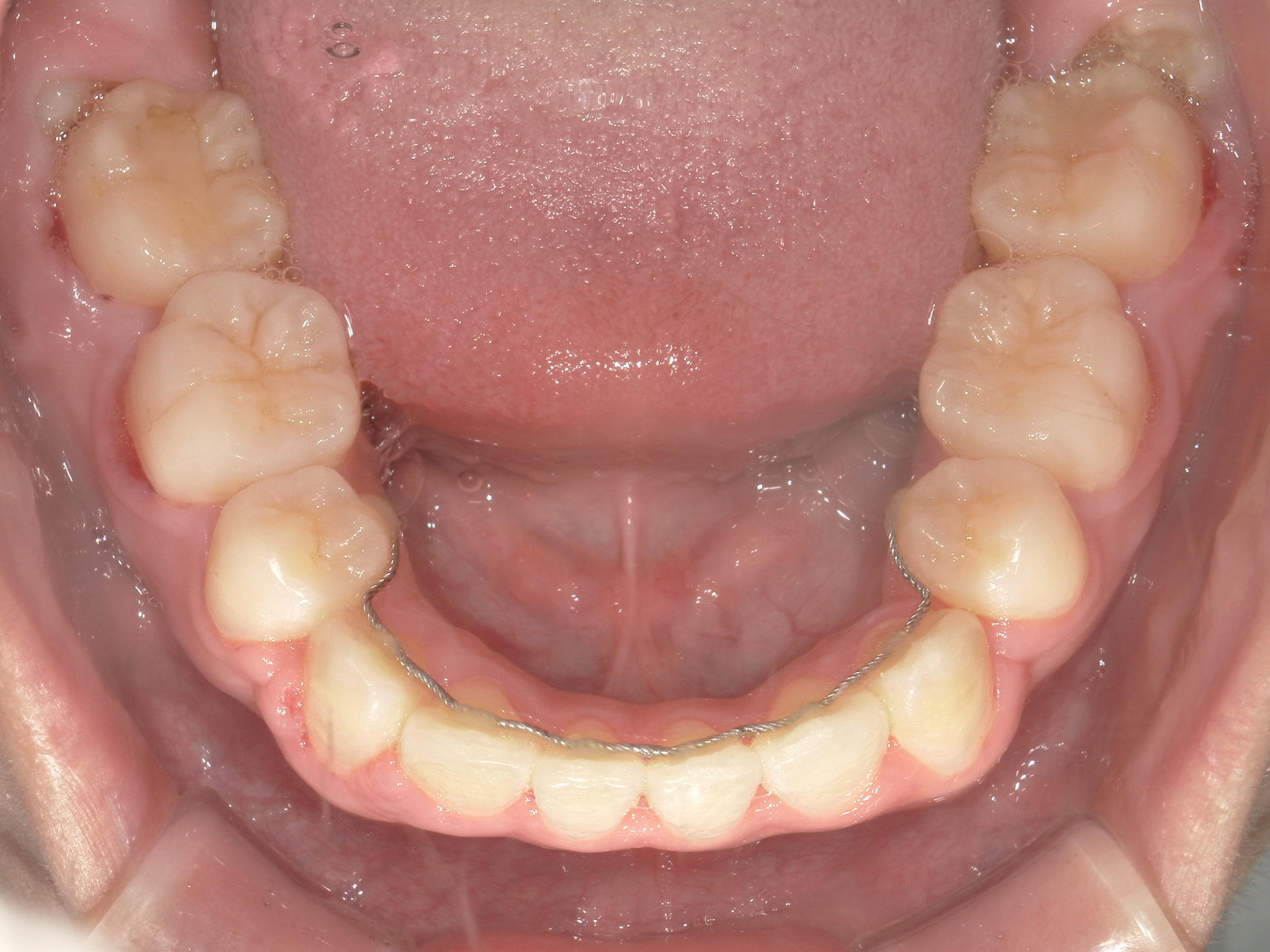 全顎ワイヤー矯正　症例（80）