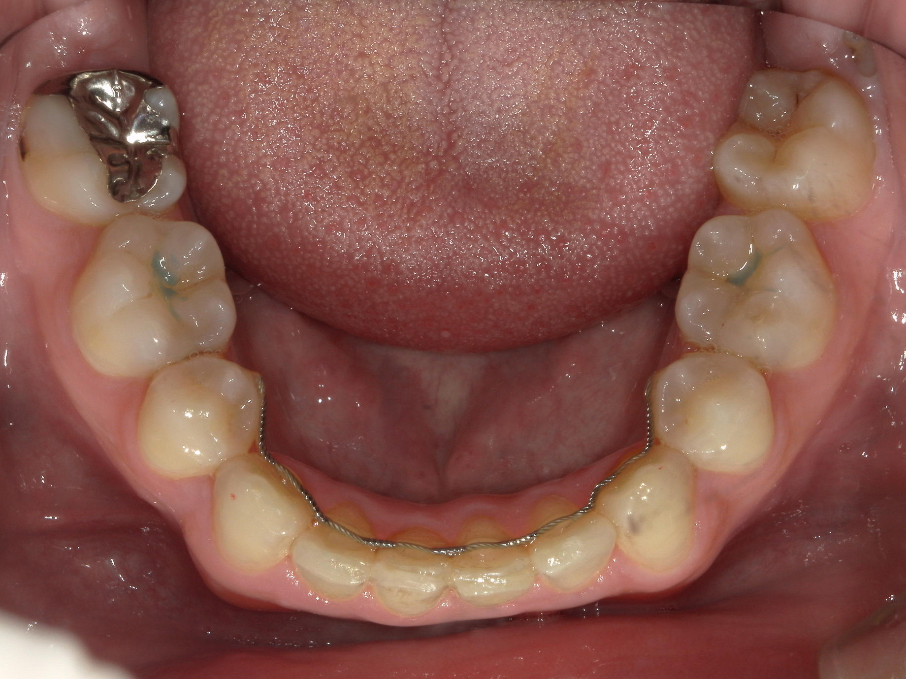 全顎ワイヤー矯正　症例（79）