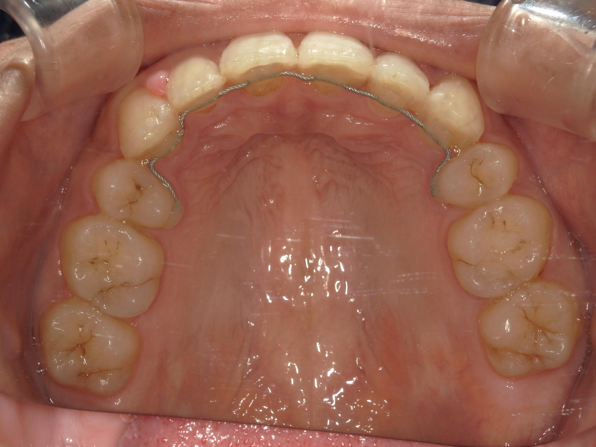 全顎ワイヤー矯正　症例（81）