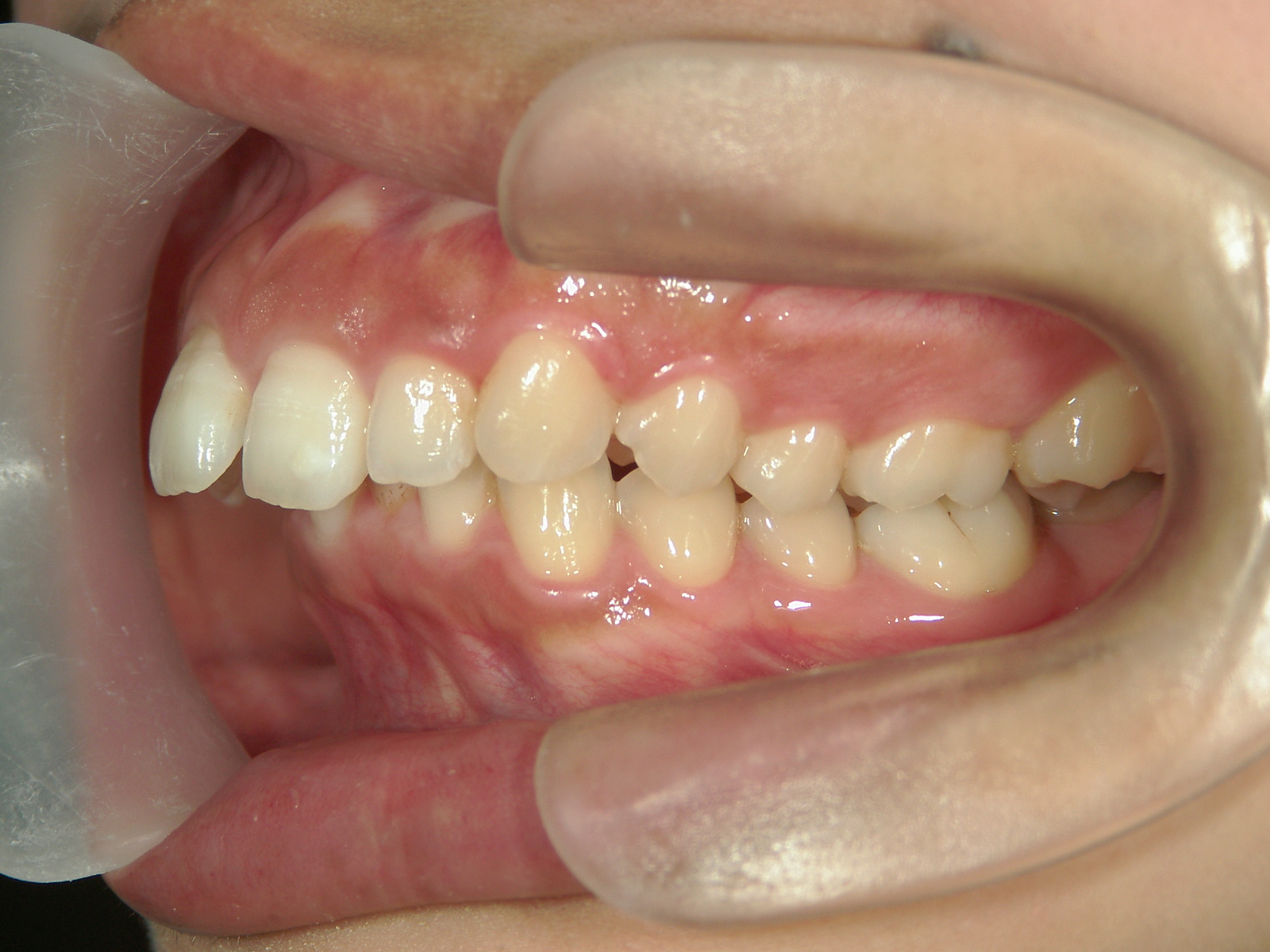 全顎ワイヤー矯正　症例（81）