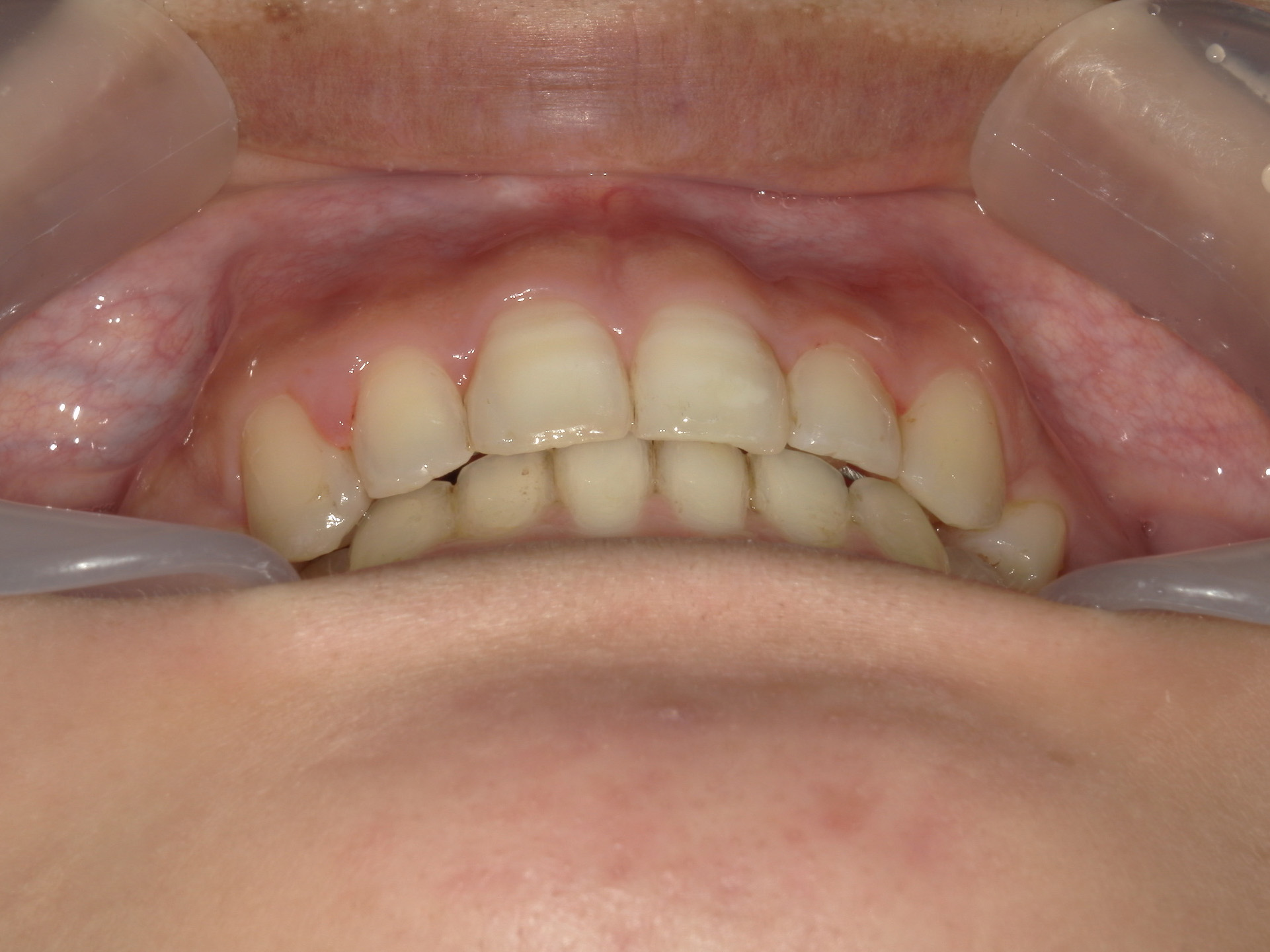 全顎ワイヤー矯正　症例（81）