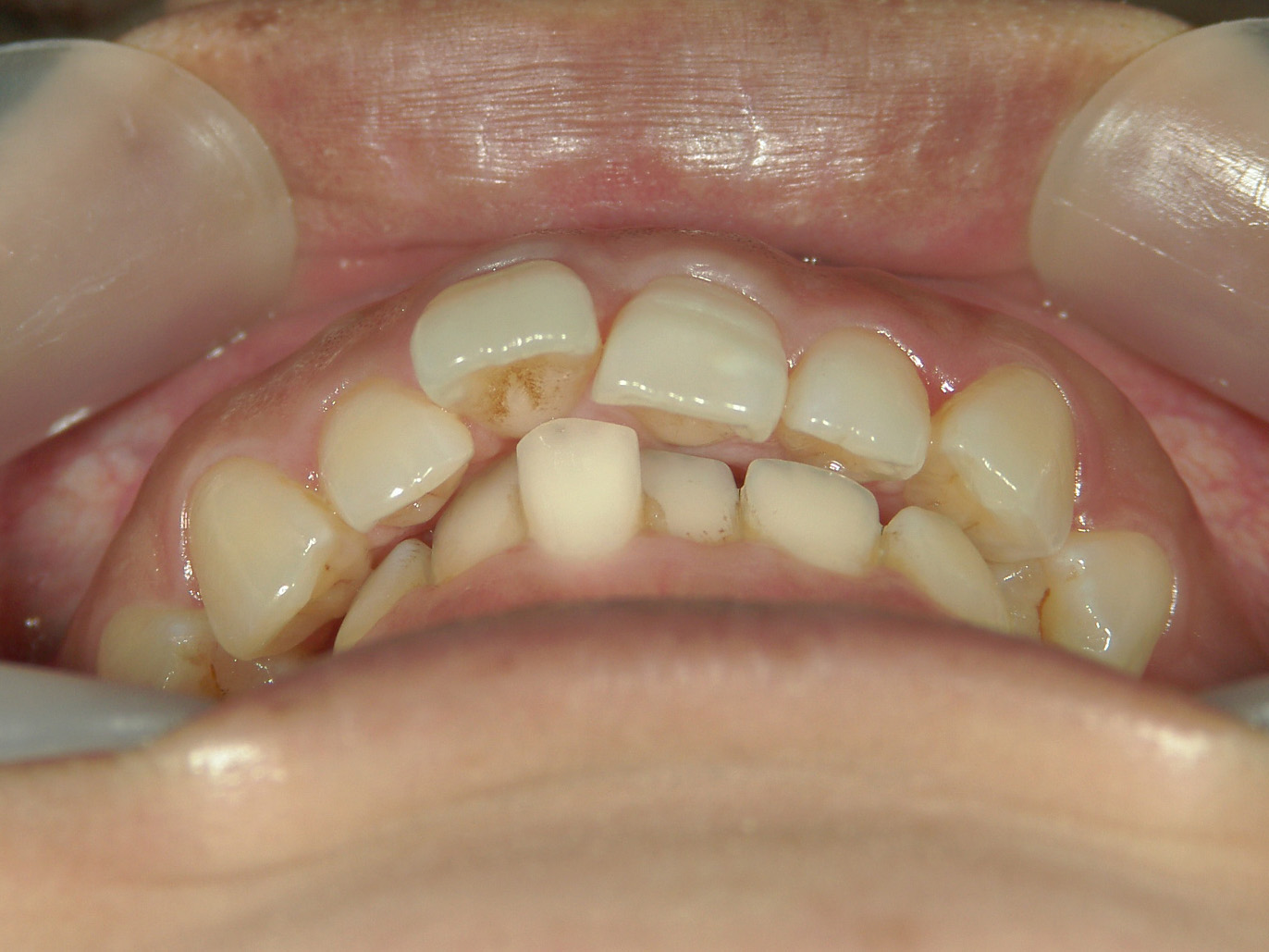 全顎ワイヤー矯正　症例（81）