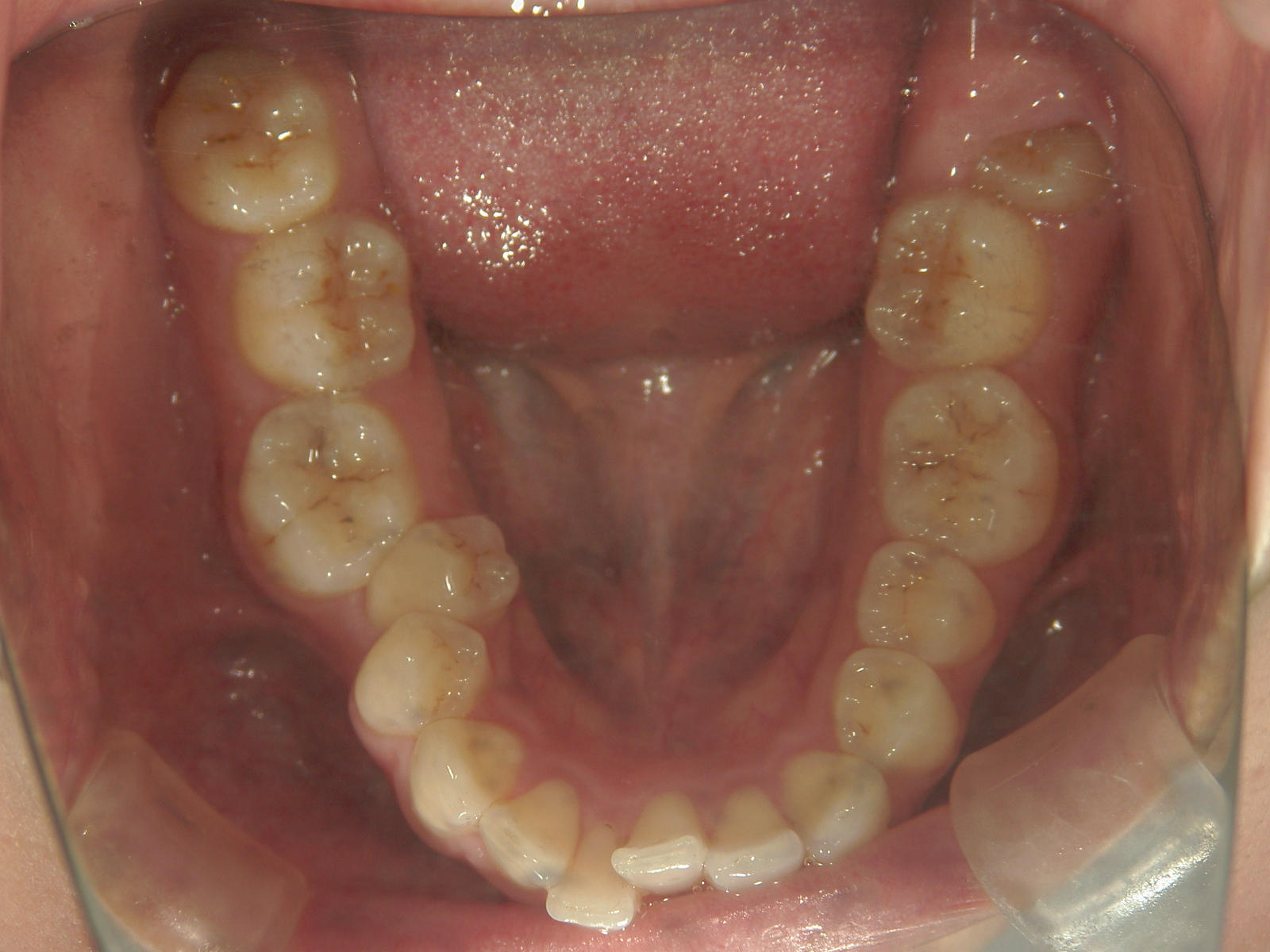 全顎ワイヤー矯正　症例（81）