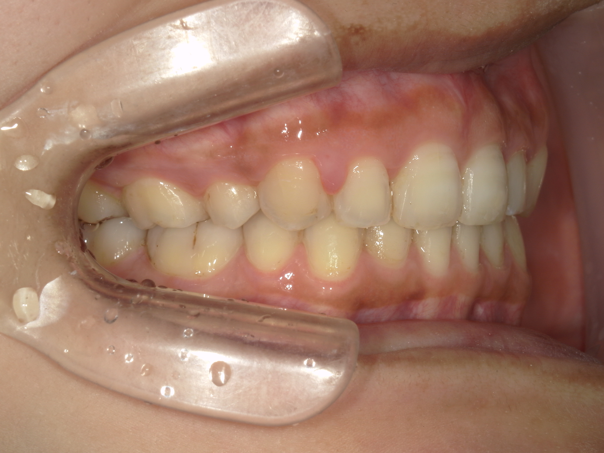 全顎ワイヤー矯正　症例（81）