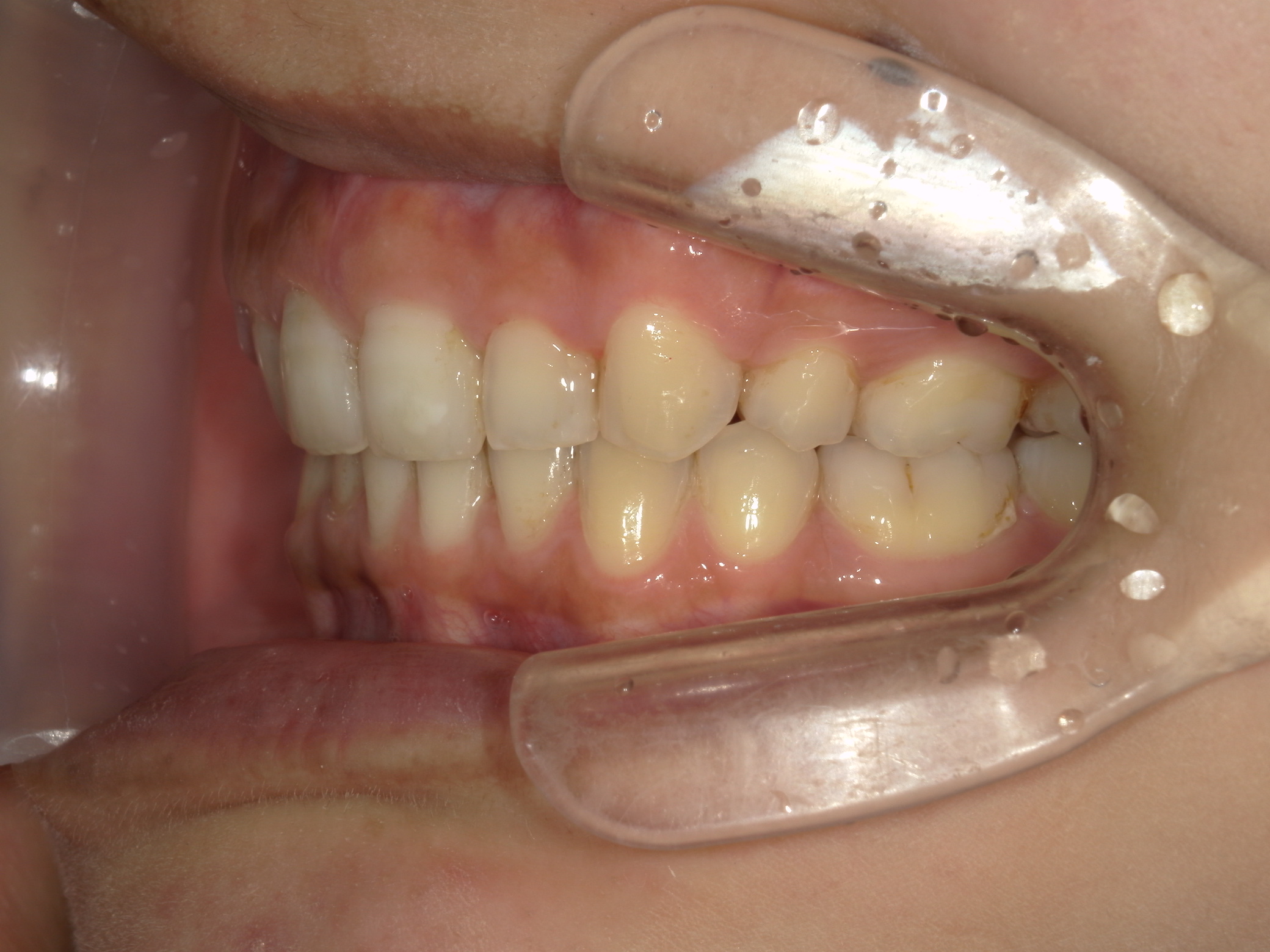 全顎ワイヤー矯正　症例（81）