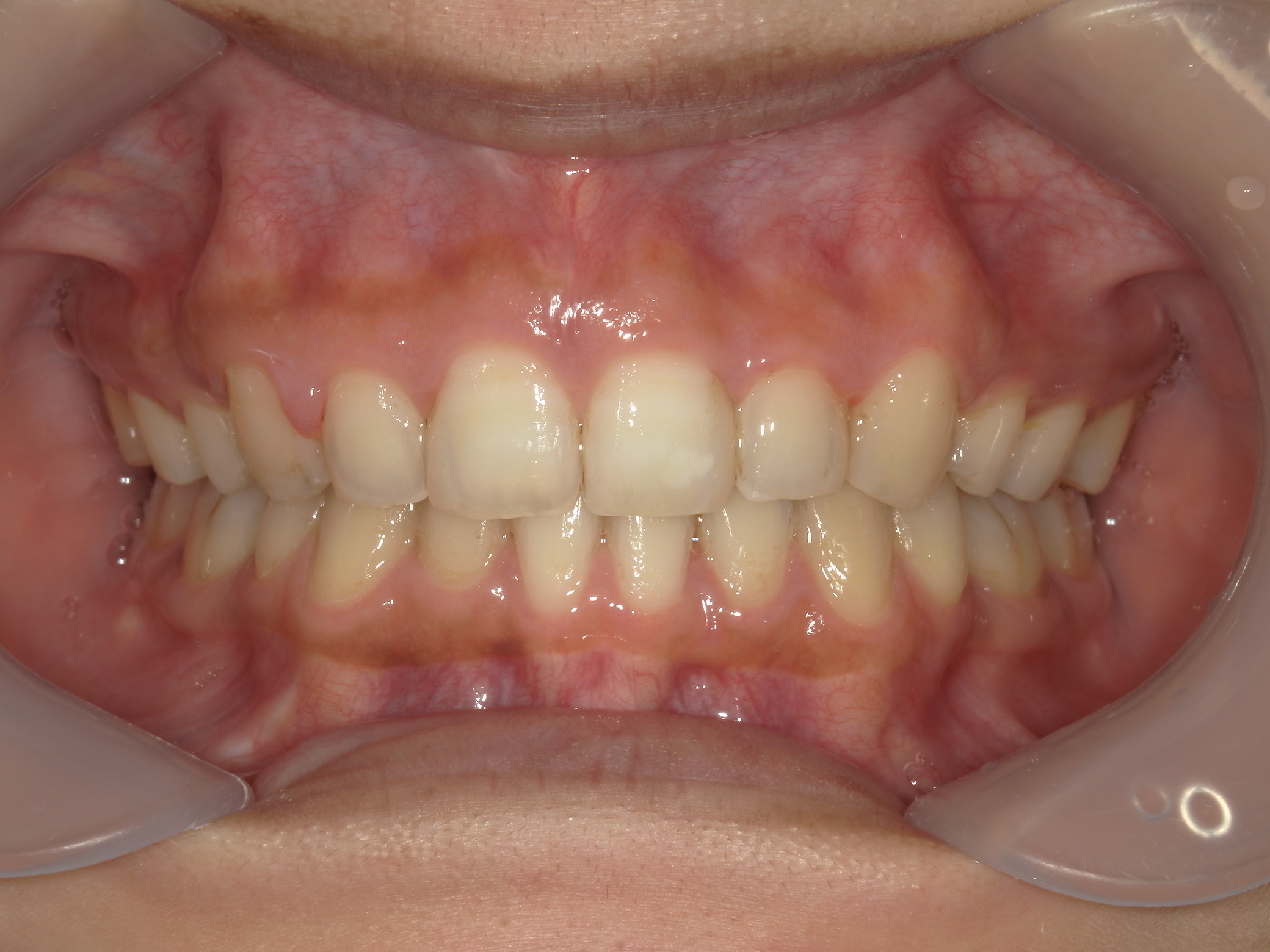 全顎ワイヤー矯正　症例（81）