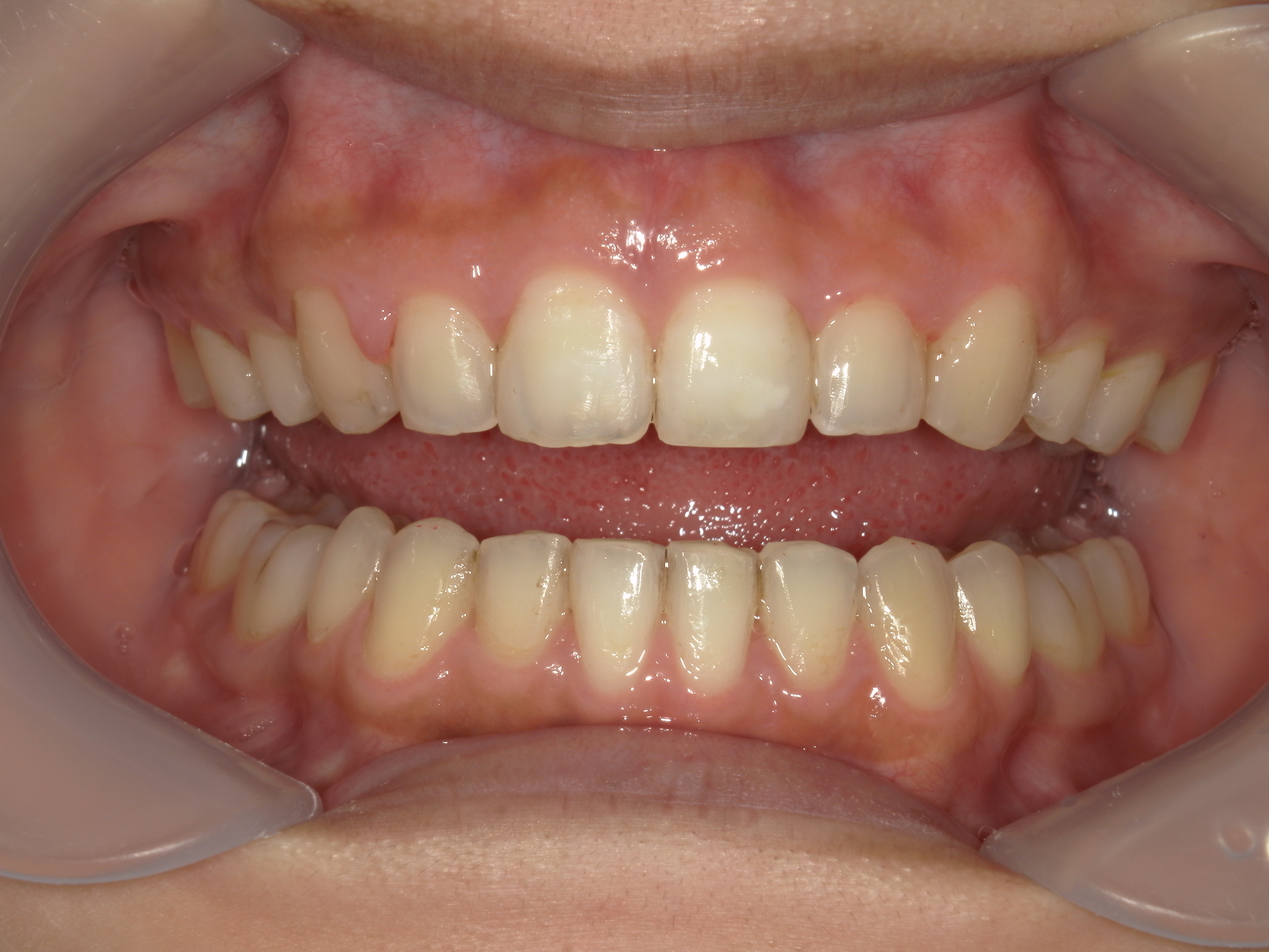 全顎ワイヤー矯正　症例（81）