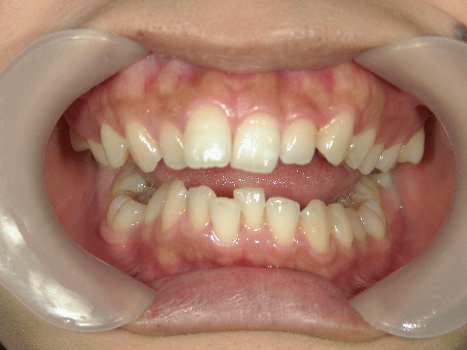 全顎ワイヤー矯正　症例（81）