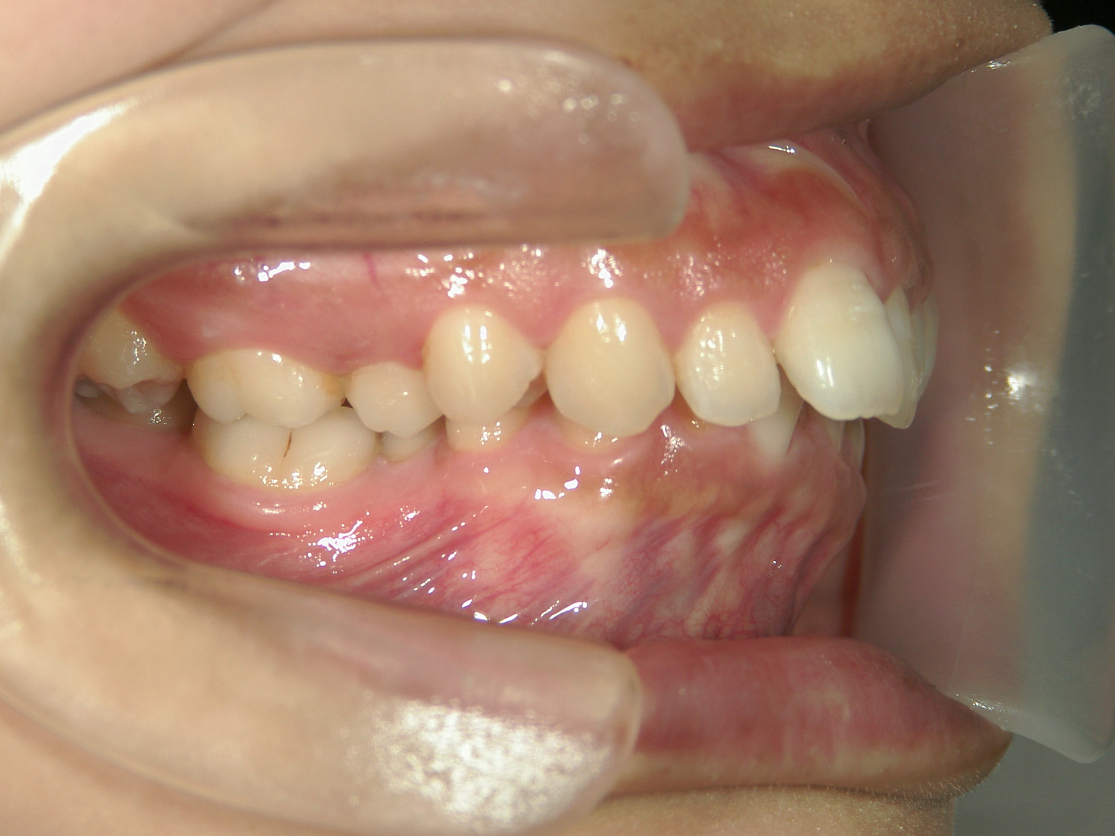 全顎ワイヤー矯正　症例（81）