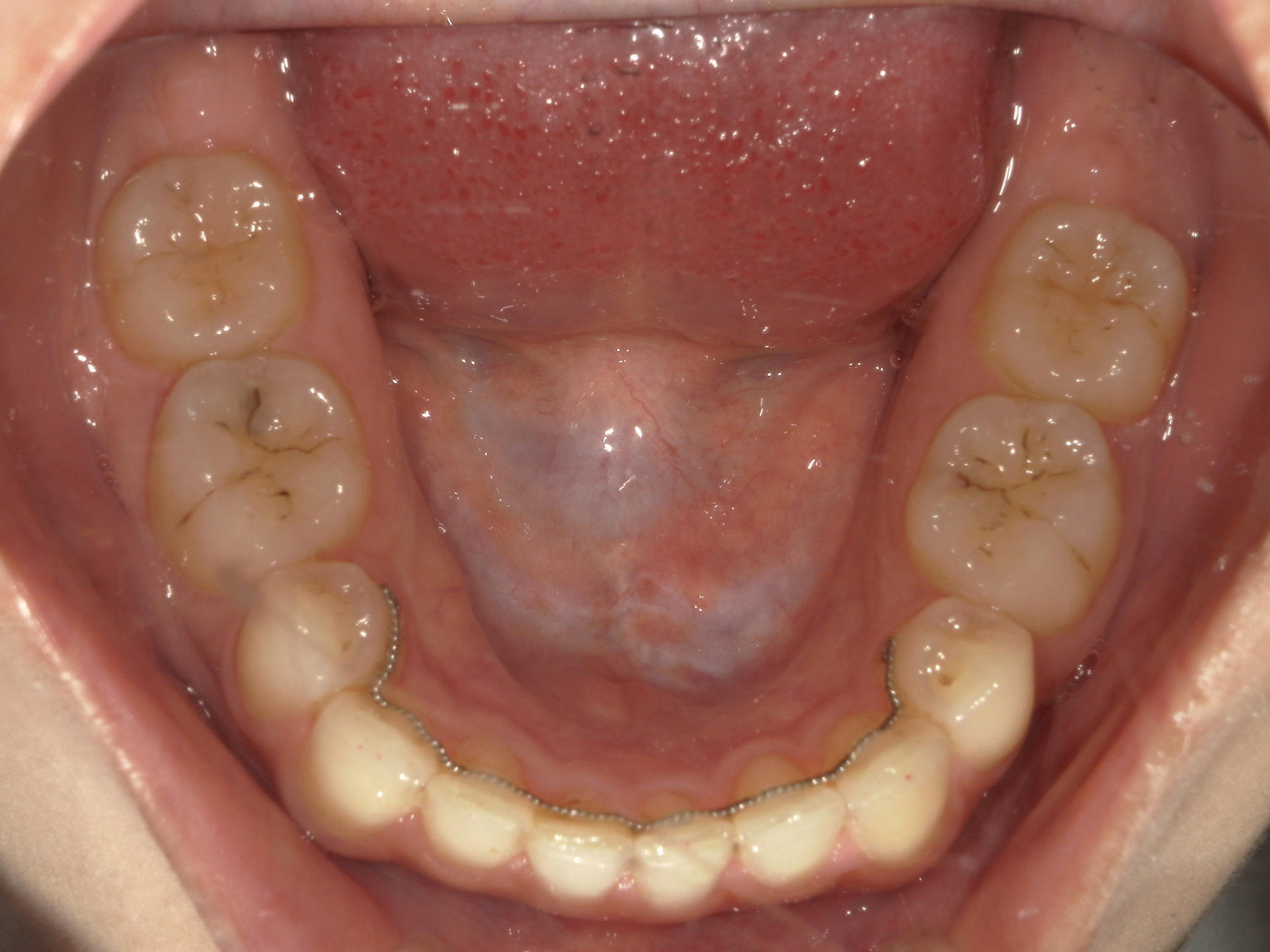 全顎ワイヤー矯正　症例（81）
