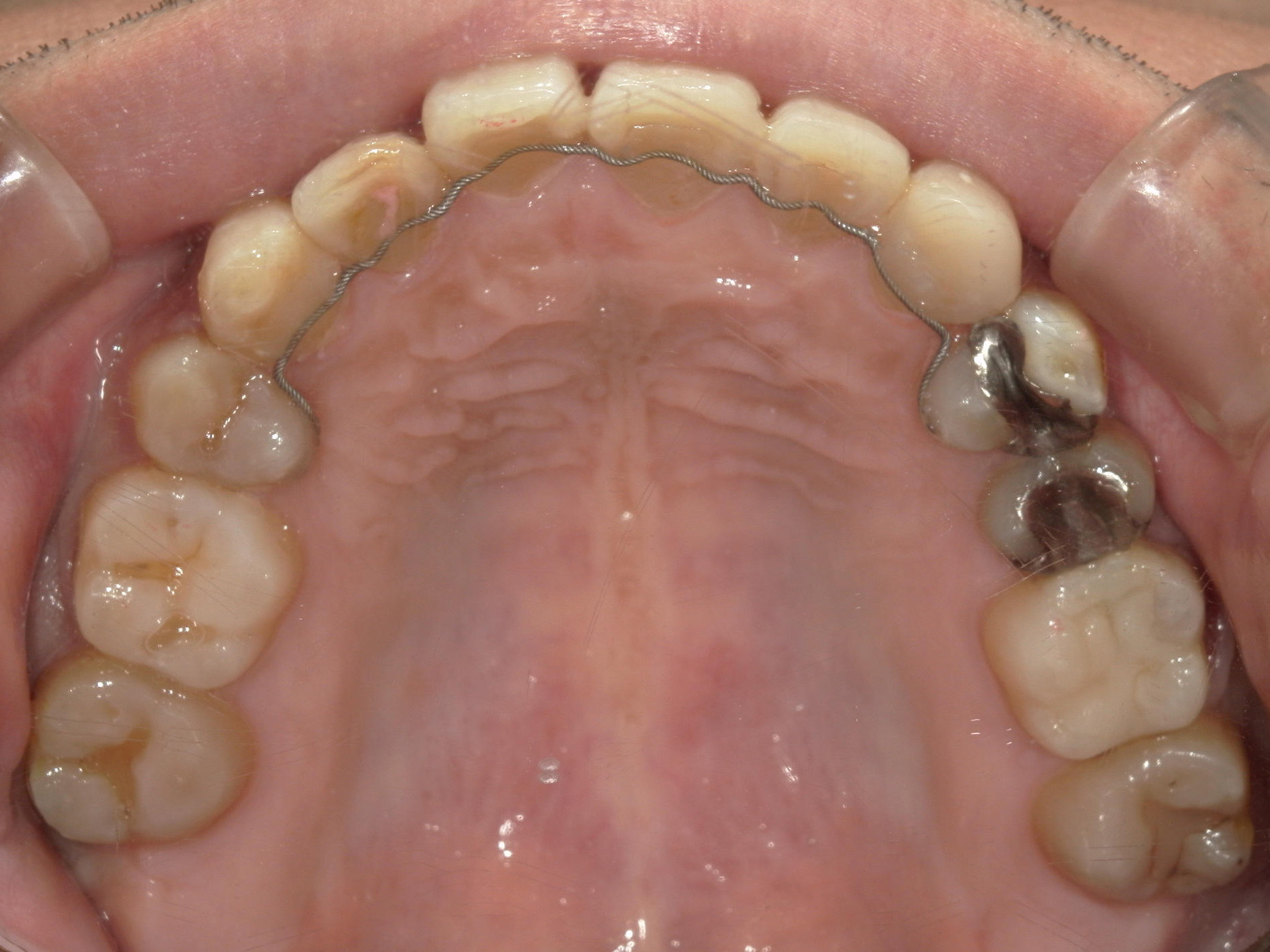 全顎ワイヤー矯正　症例（83）