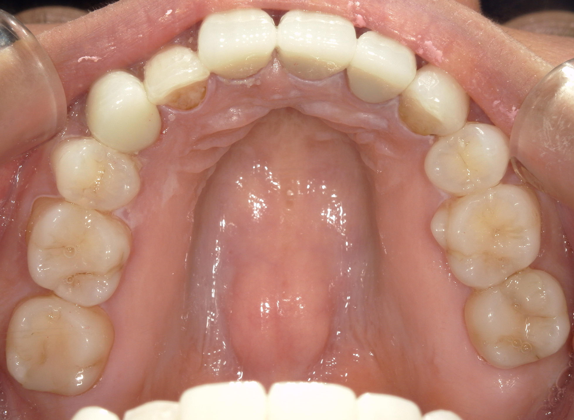全顎ワイヤー矯正　症例（82）