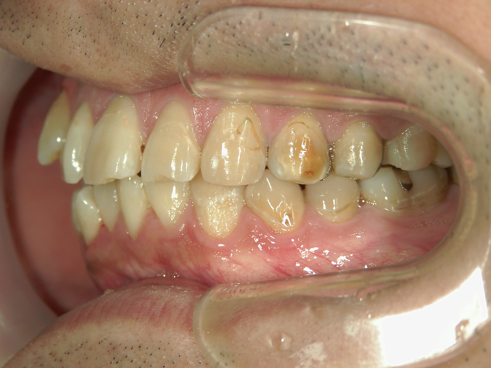 全顎ワイヤー矯正　症例（83）