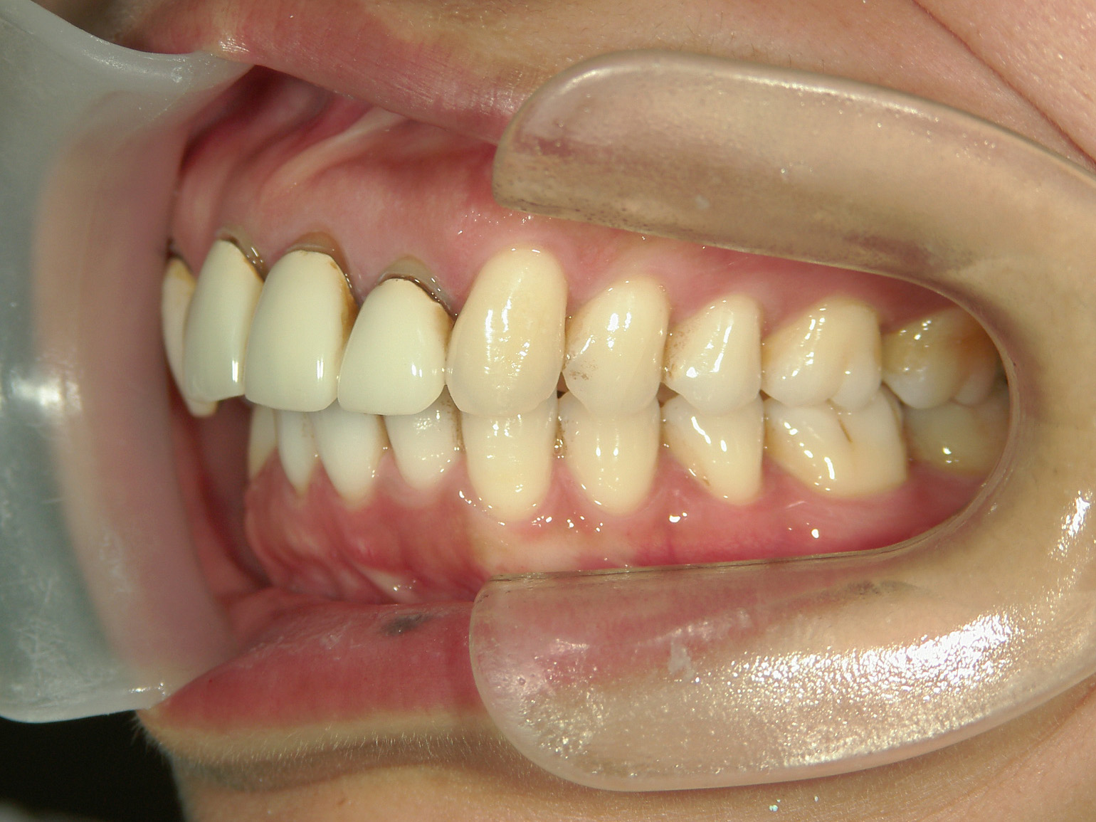 全顎ワイヤー矯正　症例（82）