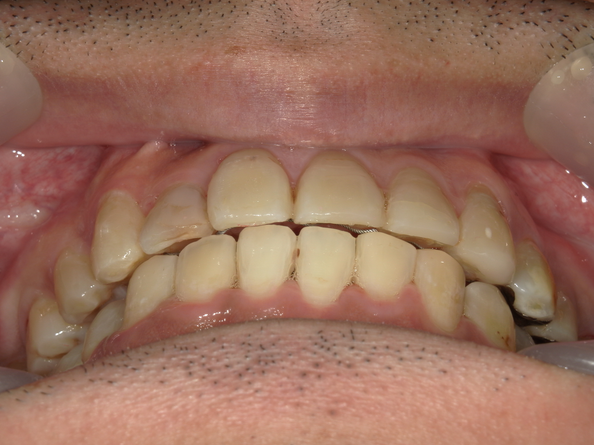 全顎ワイヤー矯正　症例（83）