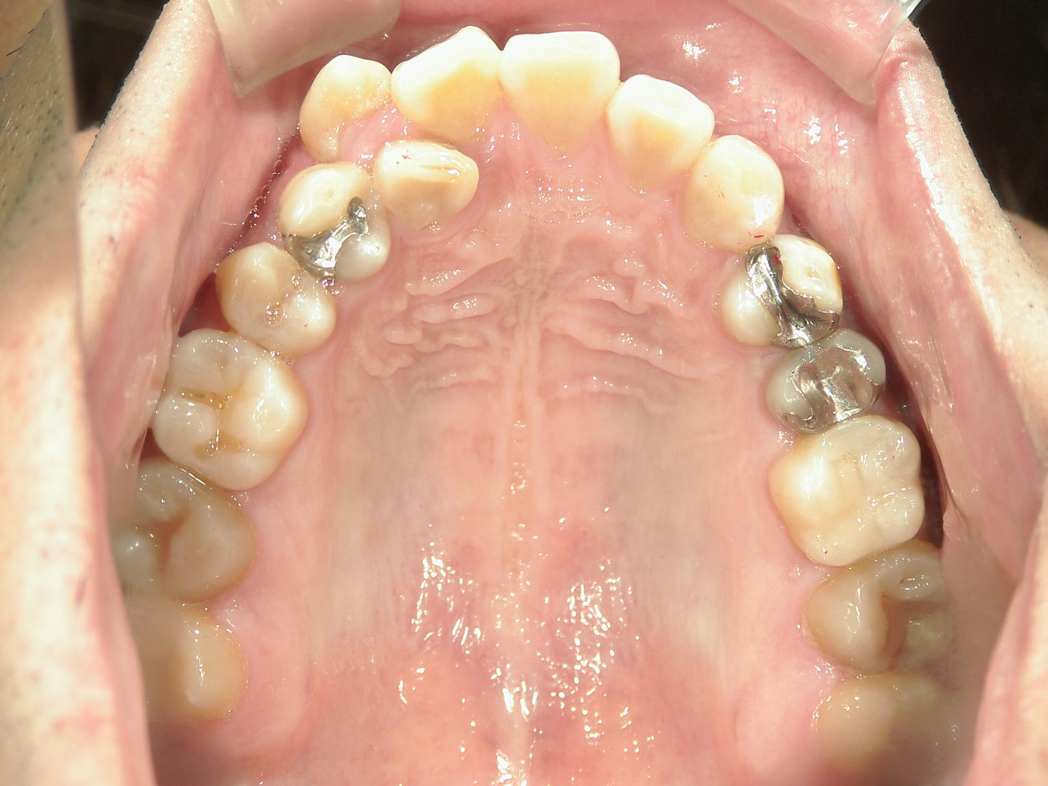 全顎ワイヤー矯正　症例（83）